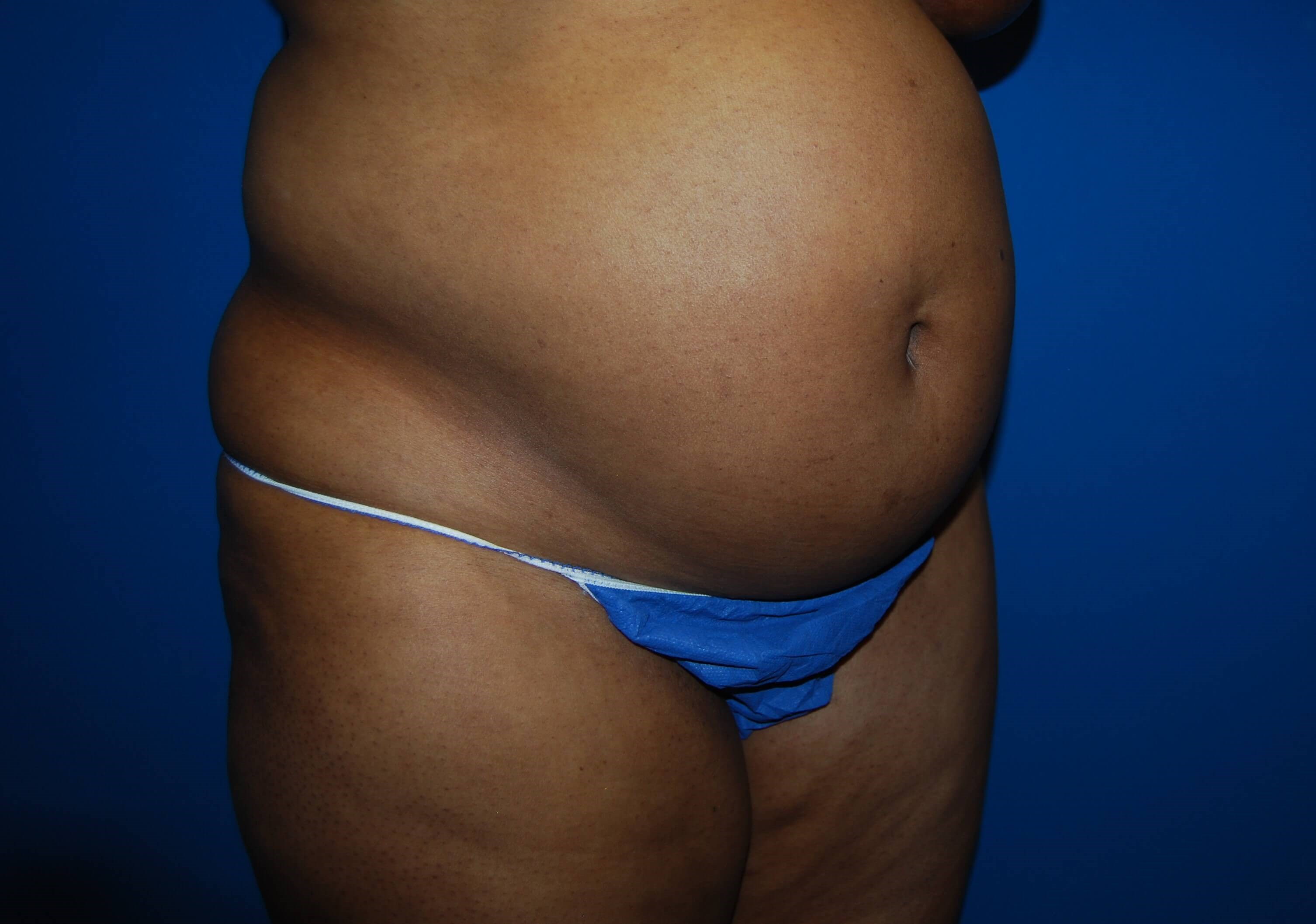 Tummy Tuck- Side Before