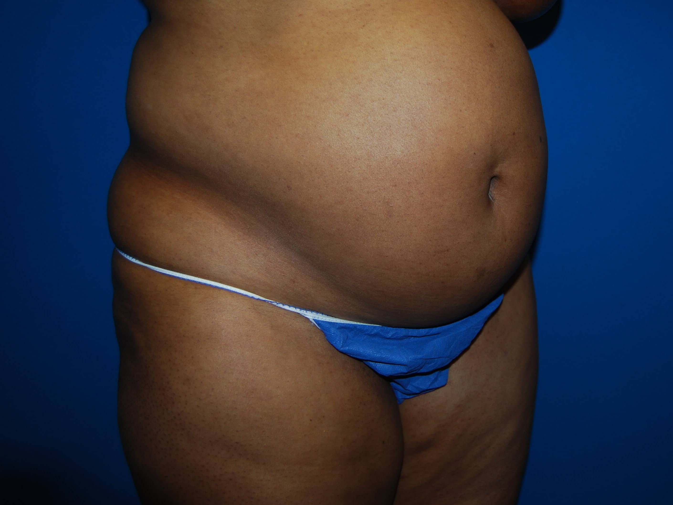Tummy Tuck- Side Before