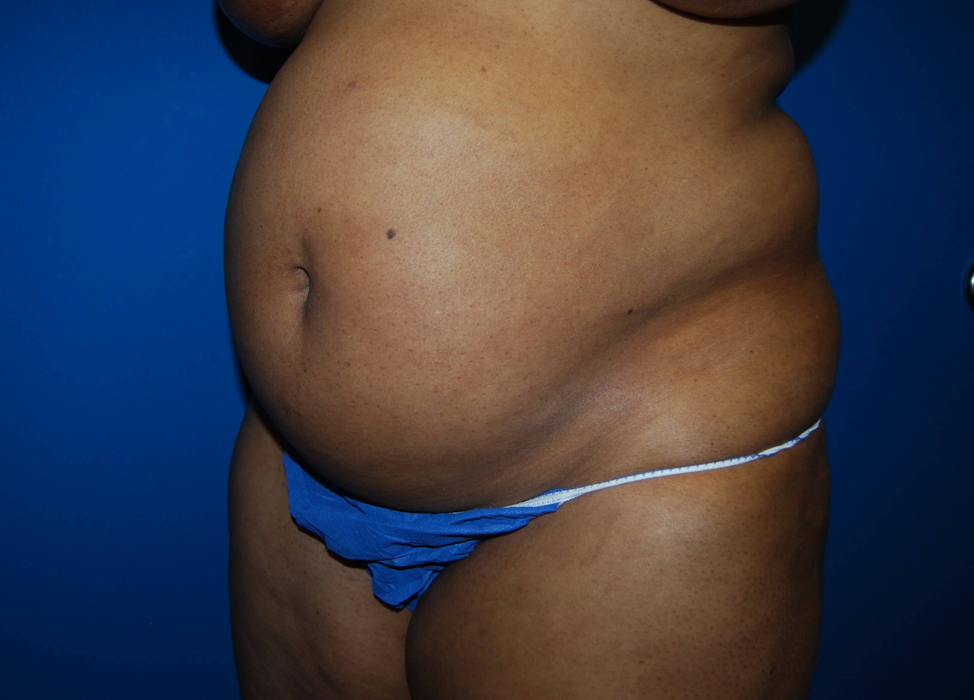 Tummy Tuck - Side Before