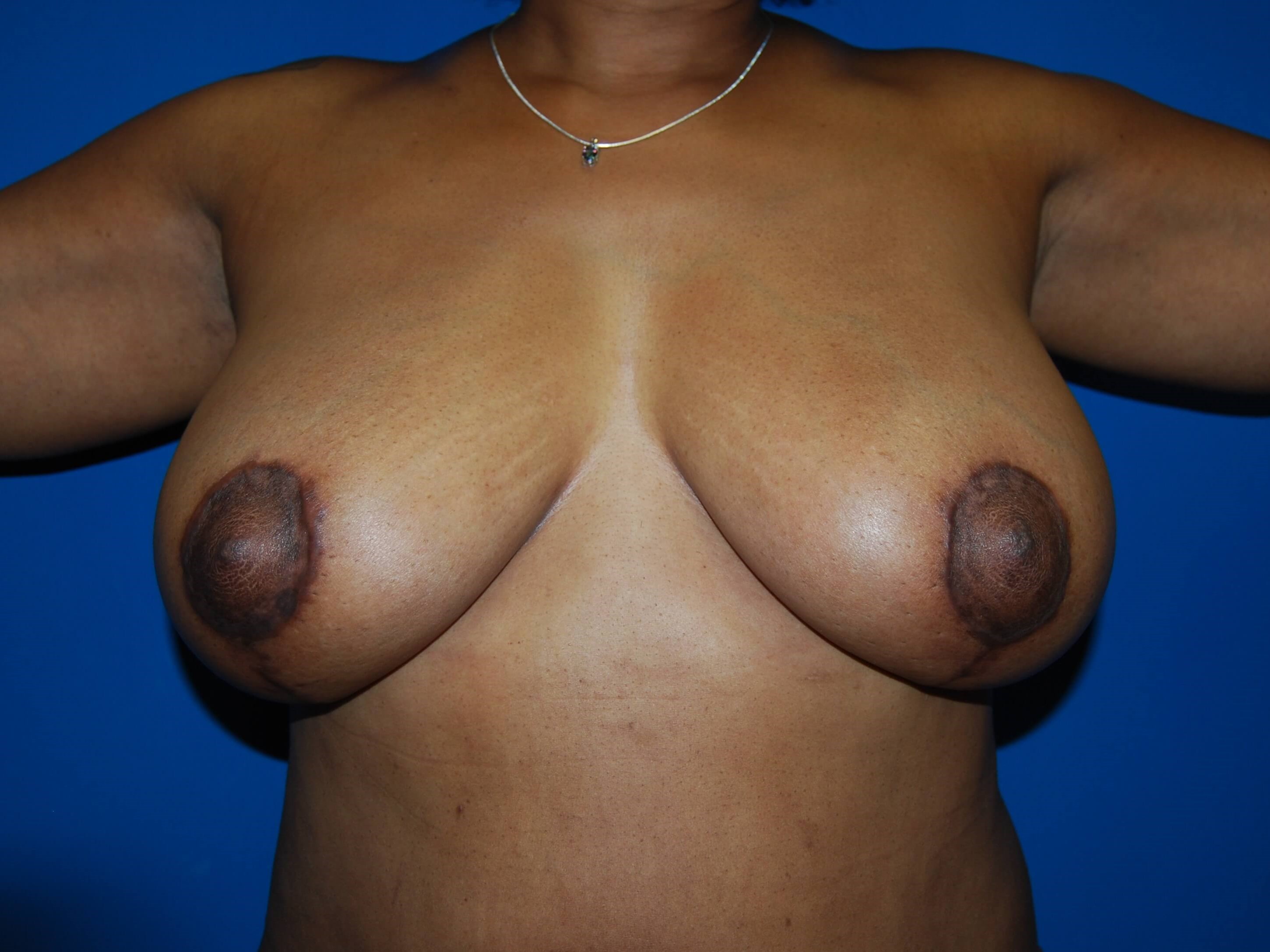 Breast Lift - Front After