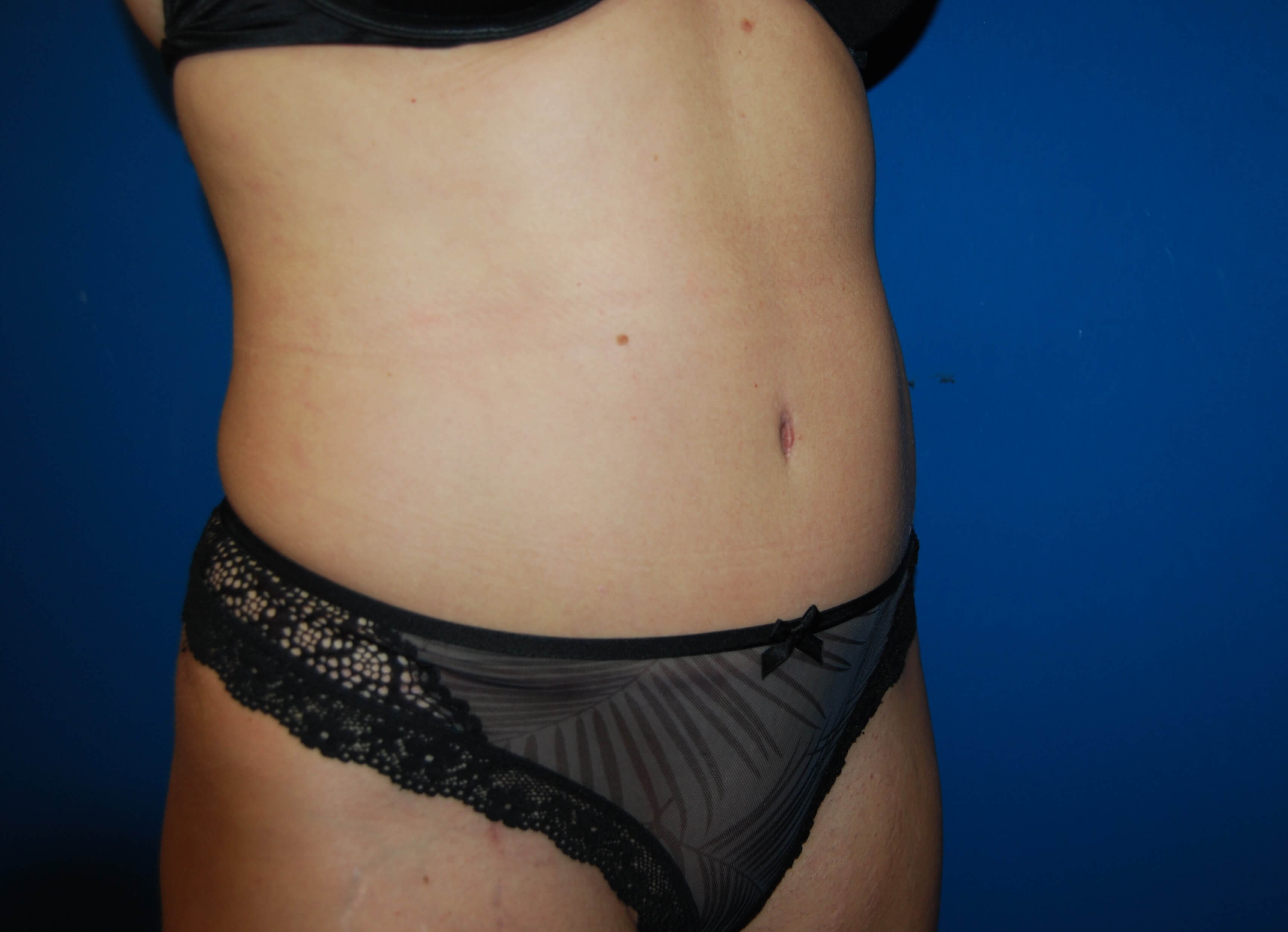 Tummy Tuck- Side After Tummy Tuck