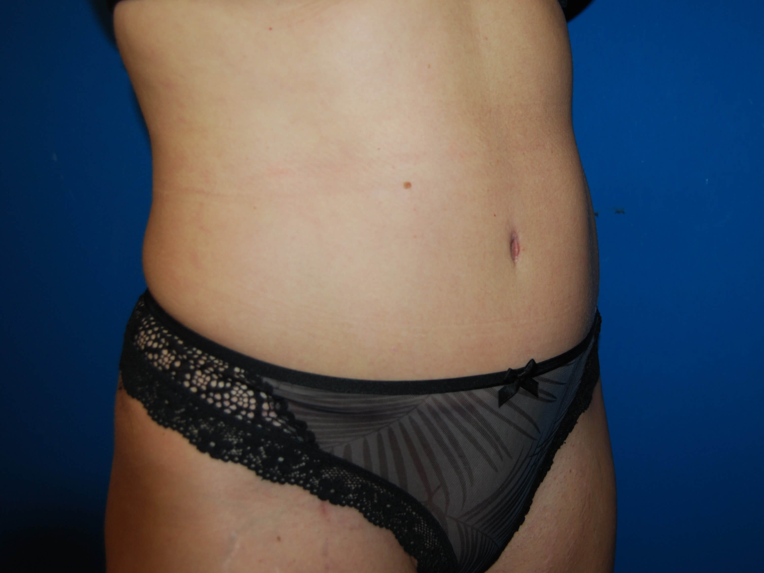Tummy Tuck- Side After Tummy Tuck