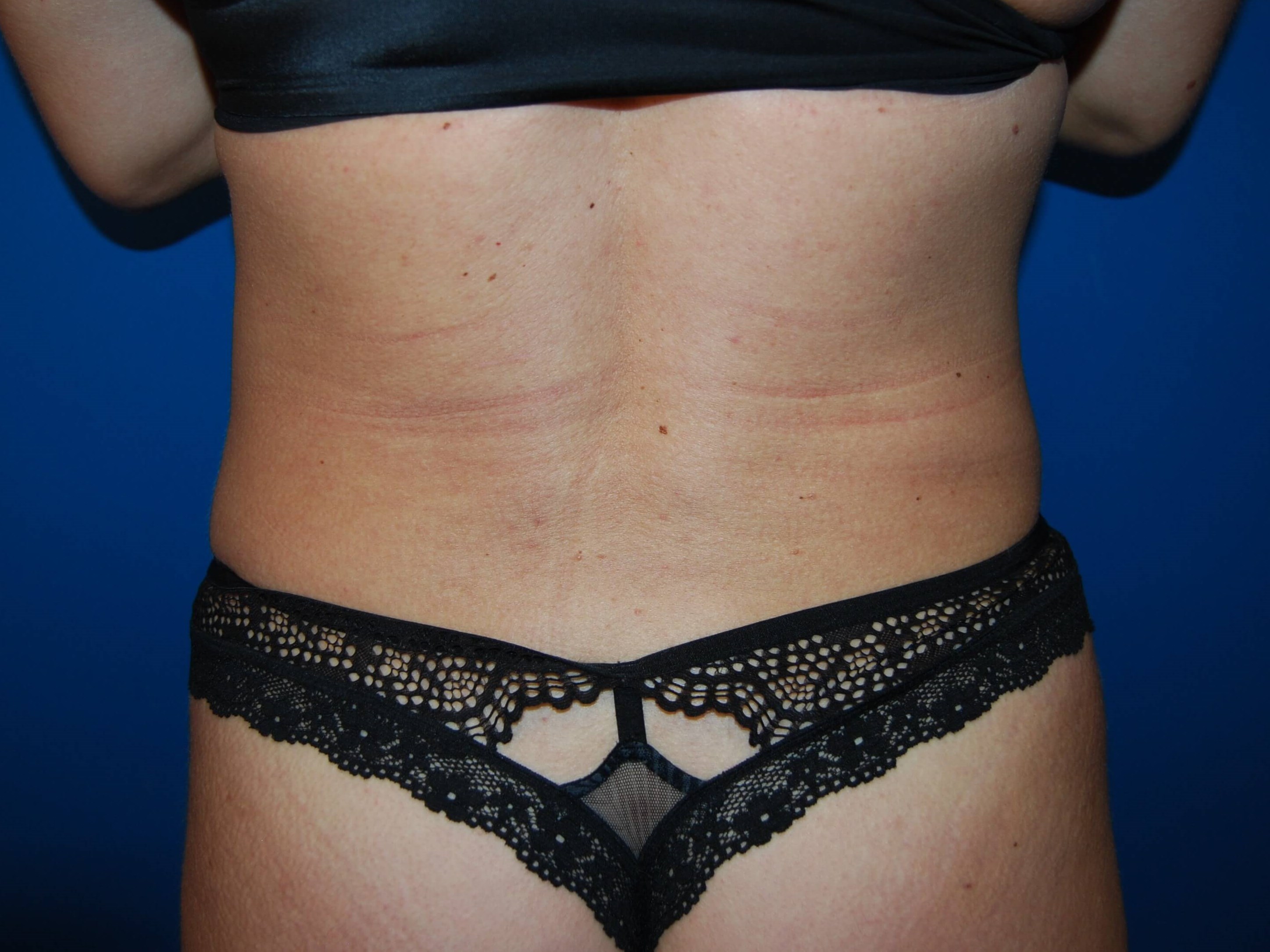 Back View After