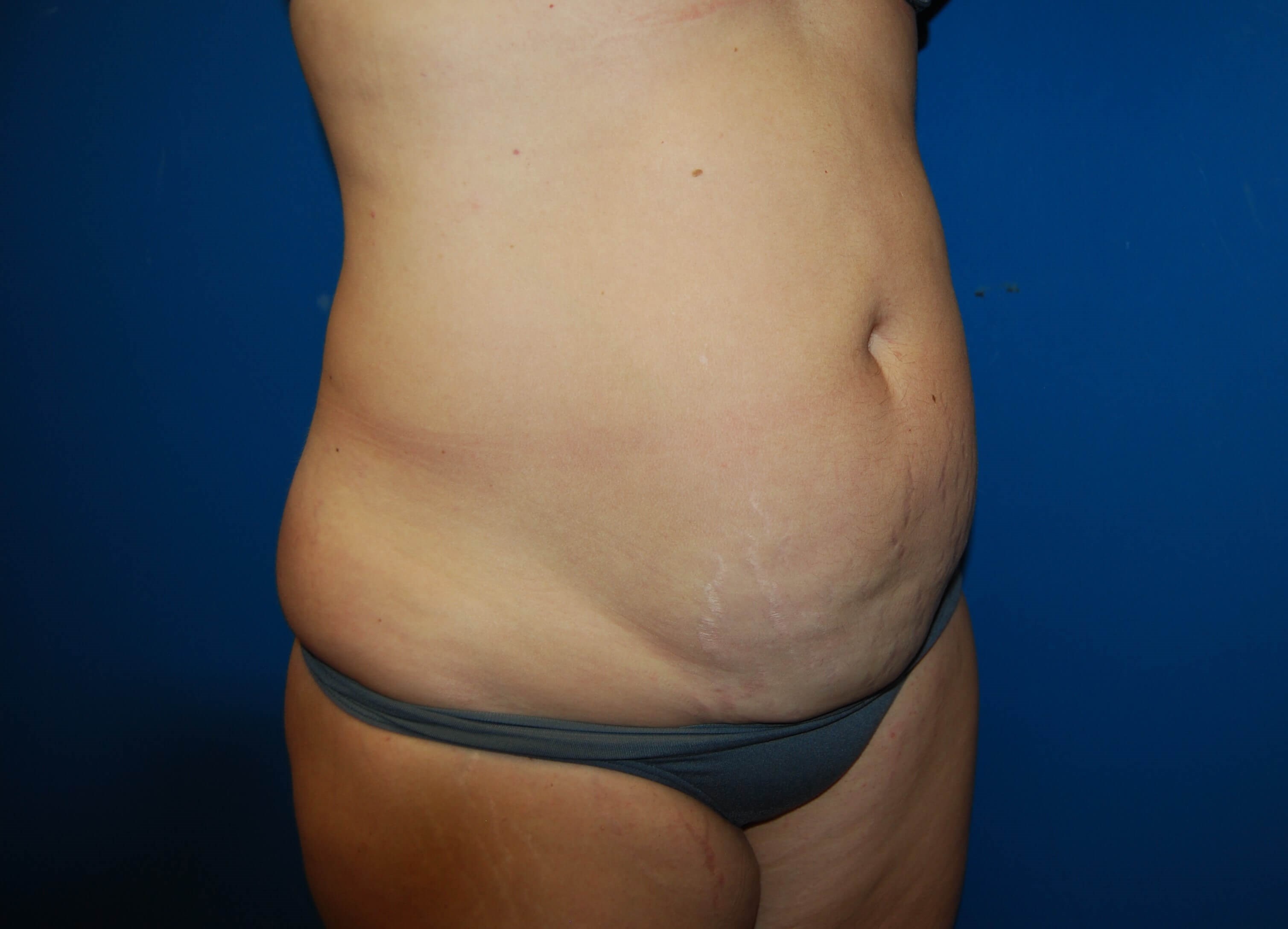Tummy Tuck- Side Before Tummy Tuck
