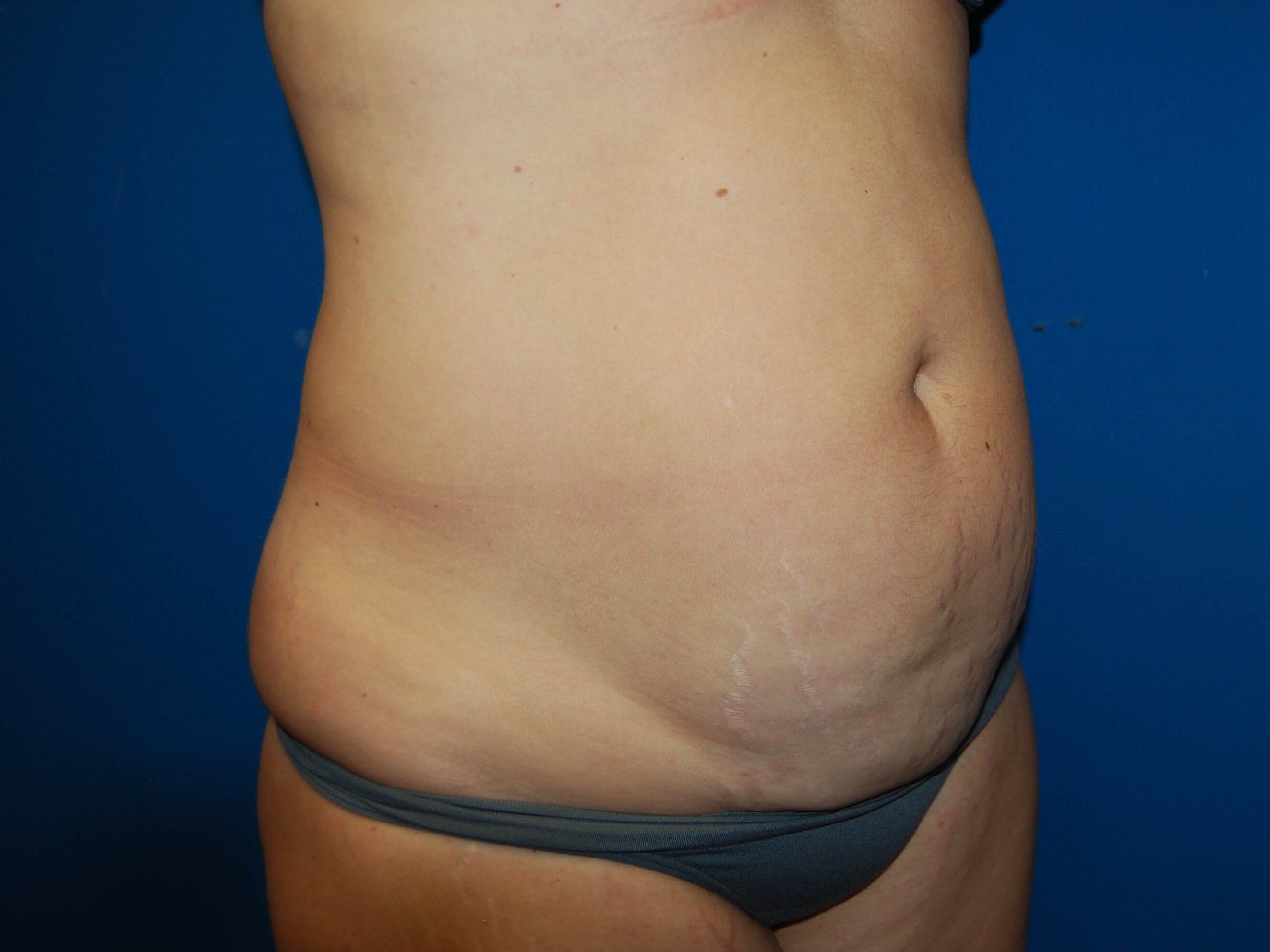 Tummy Tuck- Side Before Tummy Tuck