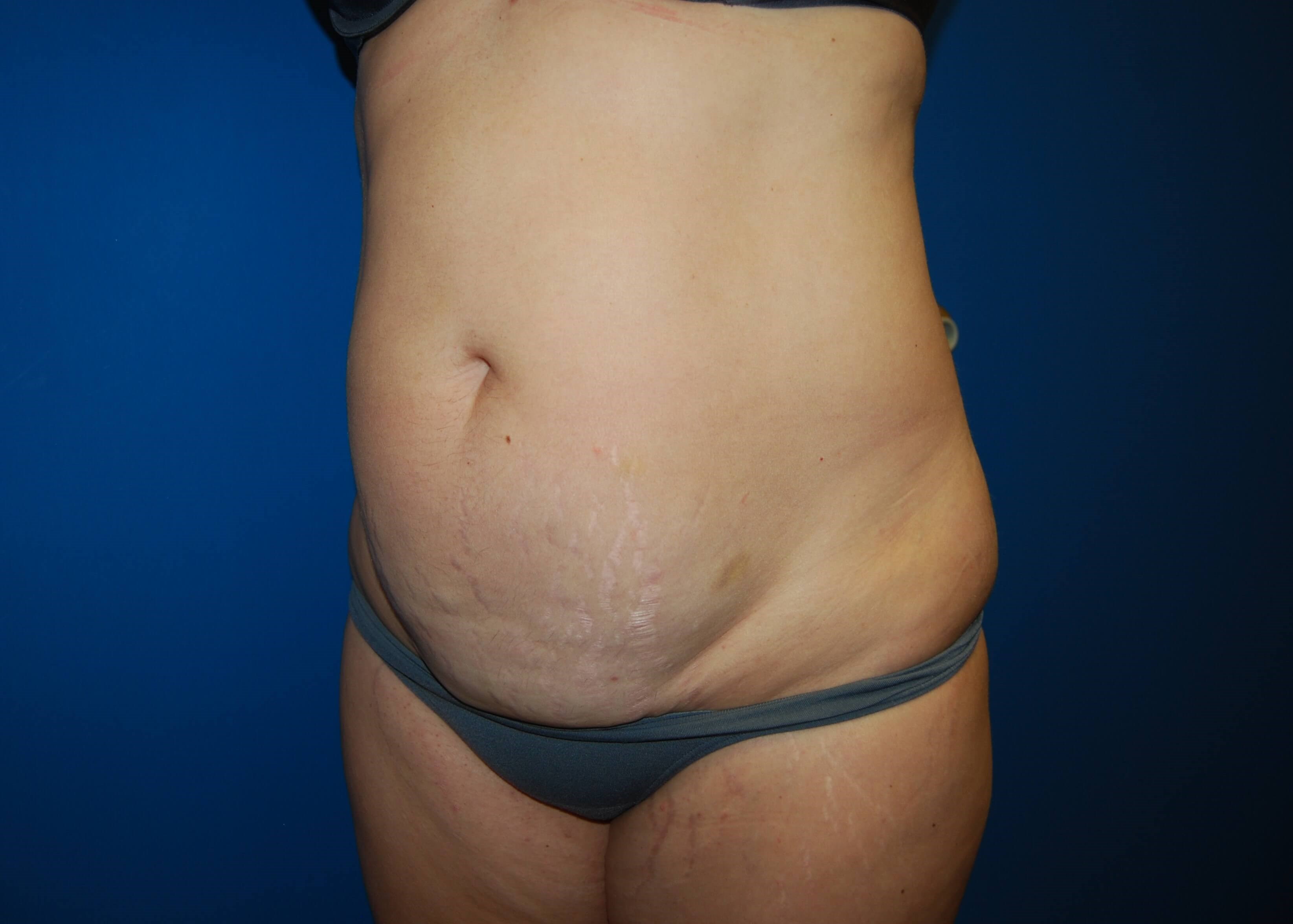 Tummy Tuck - Side Before