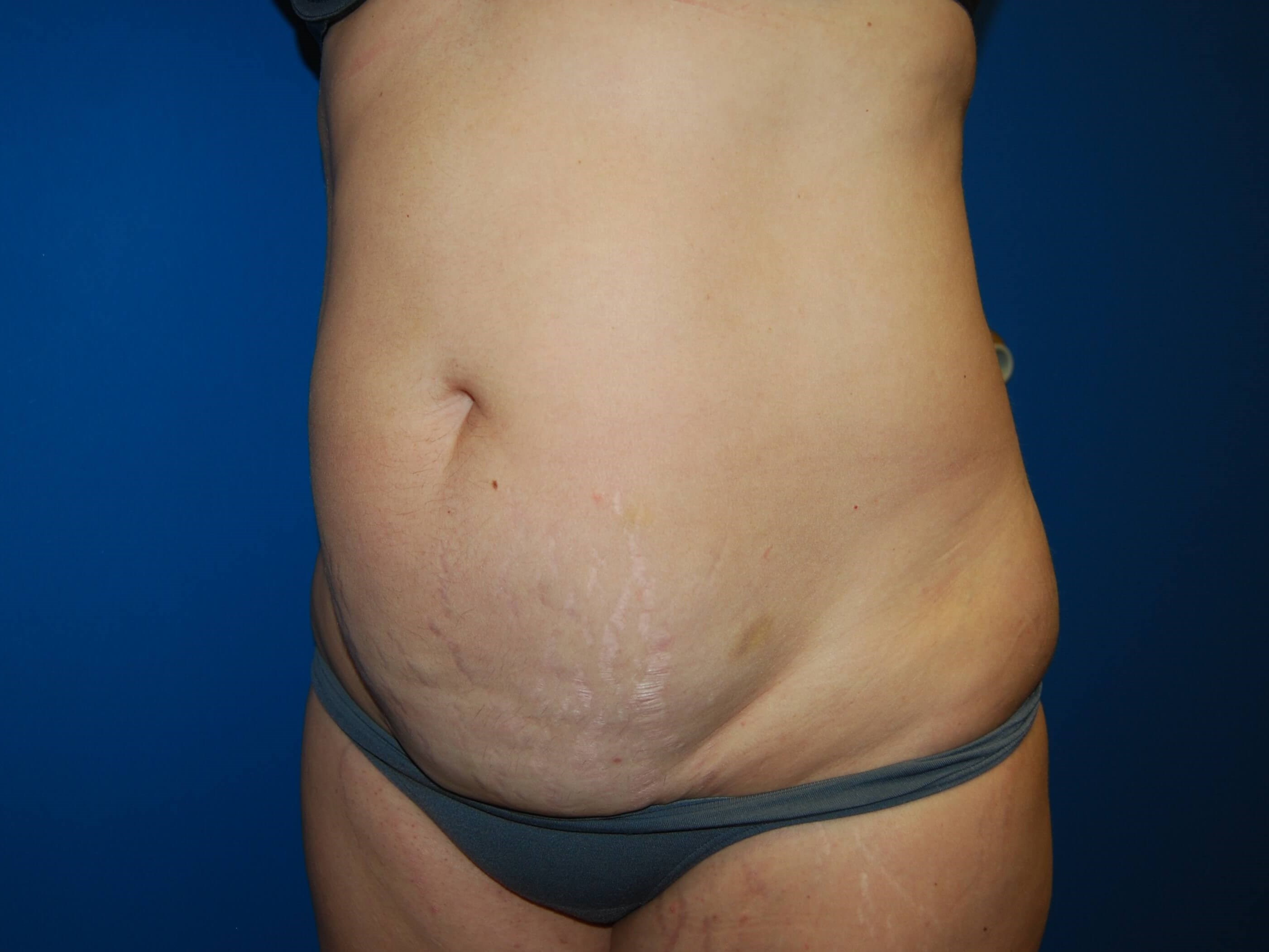Tummy Tuck - Side Before
