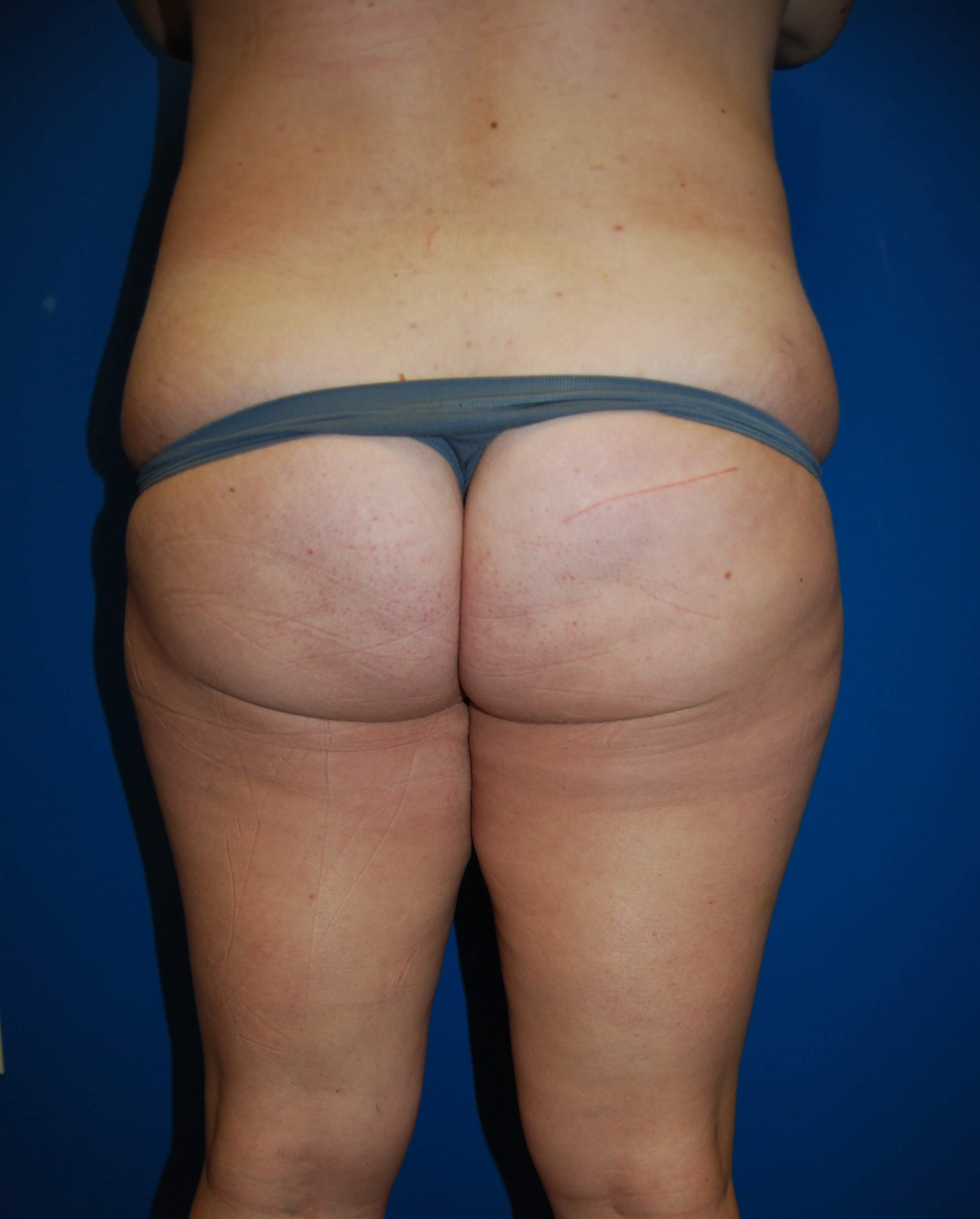 Back View Before