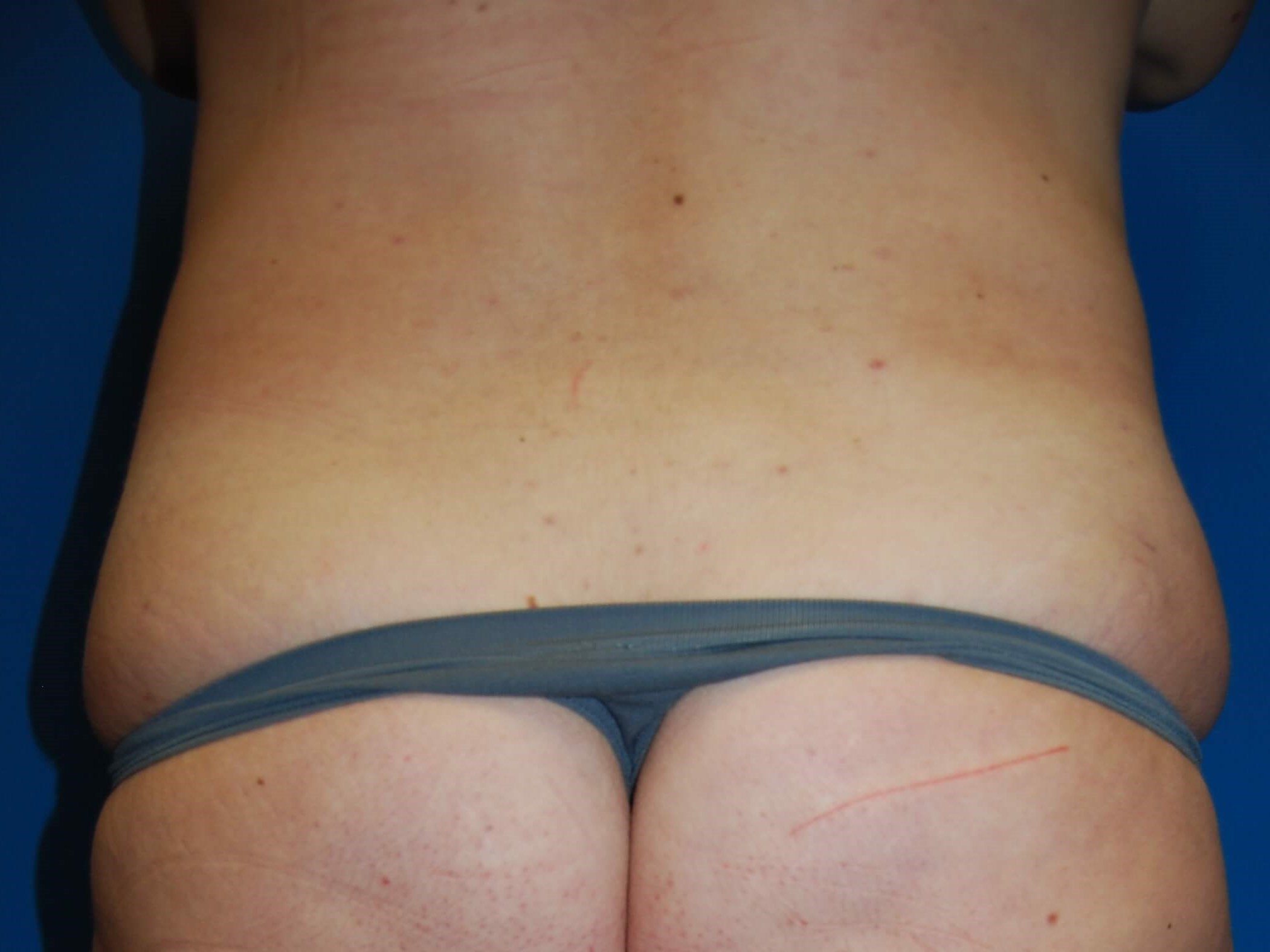 Back View Before