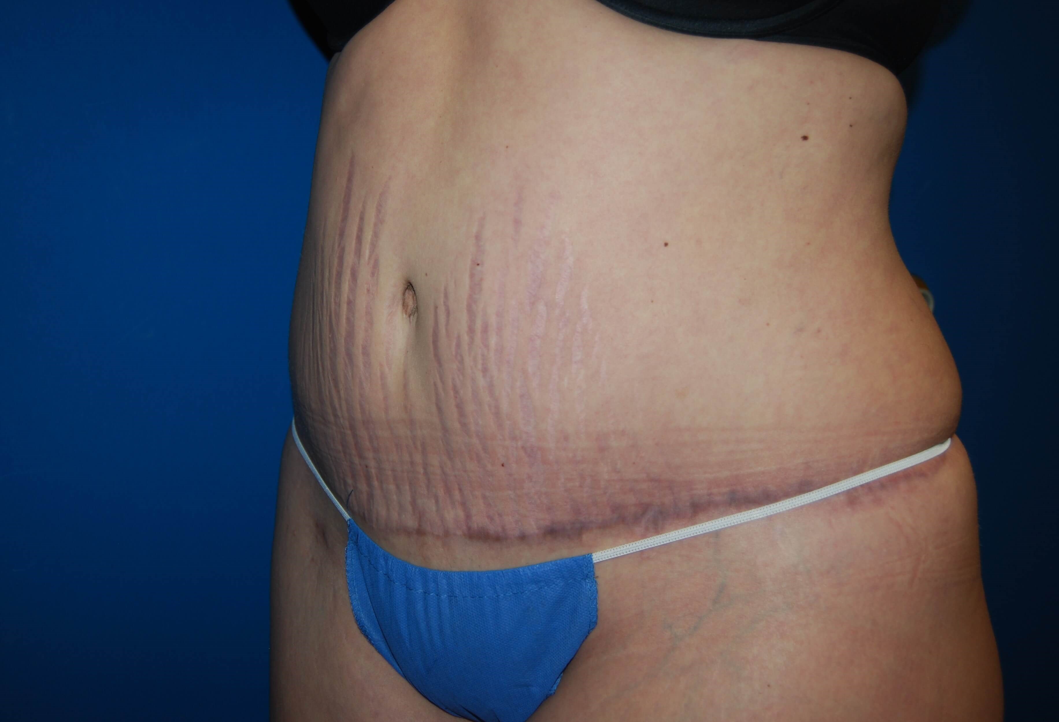 Tummy Tuck - Side After