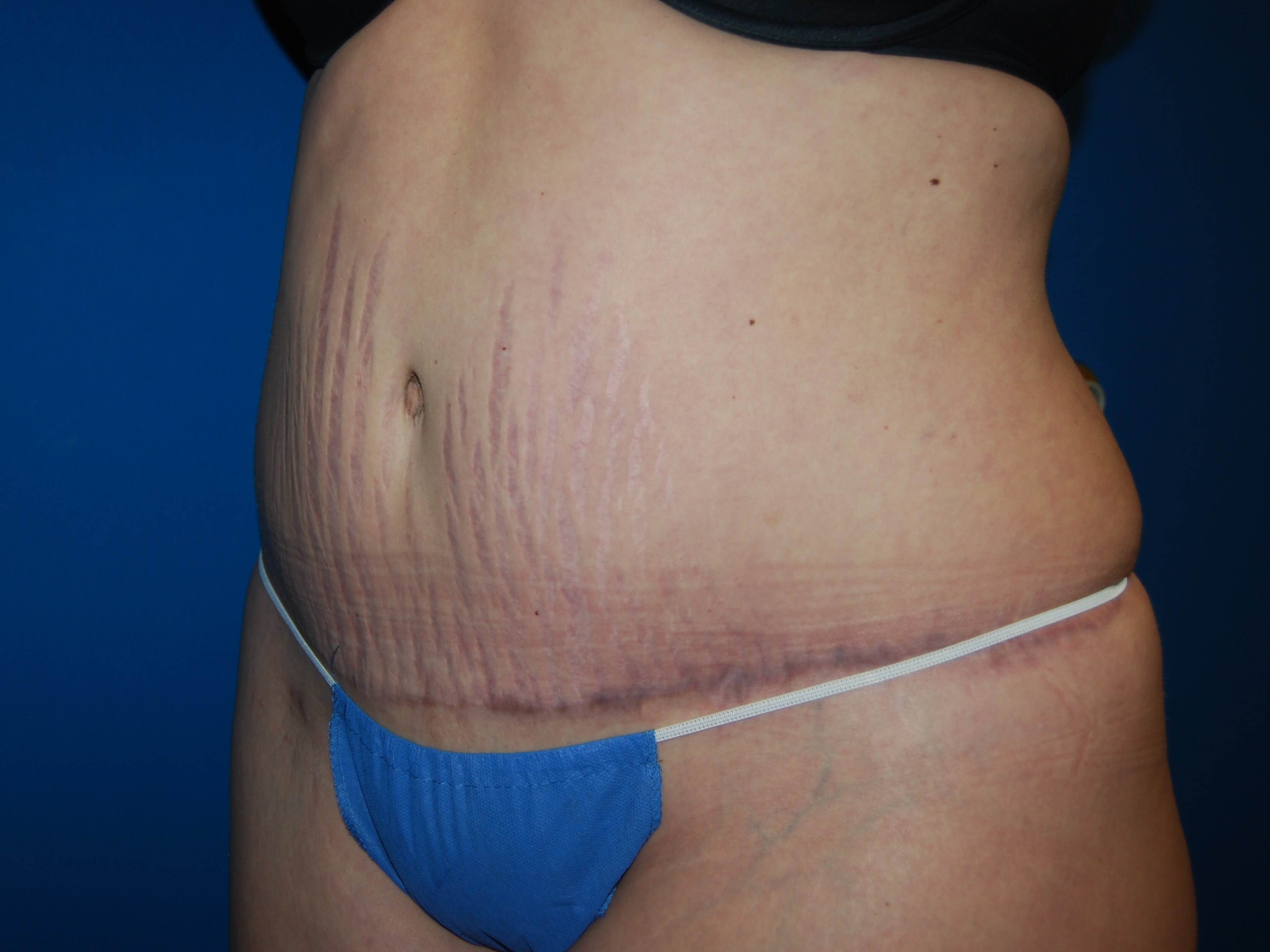 Tummy Tuck - Side After