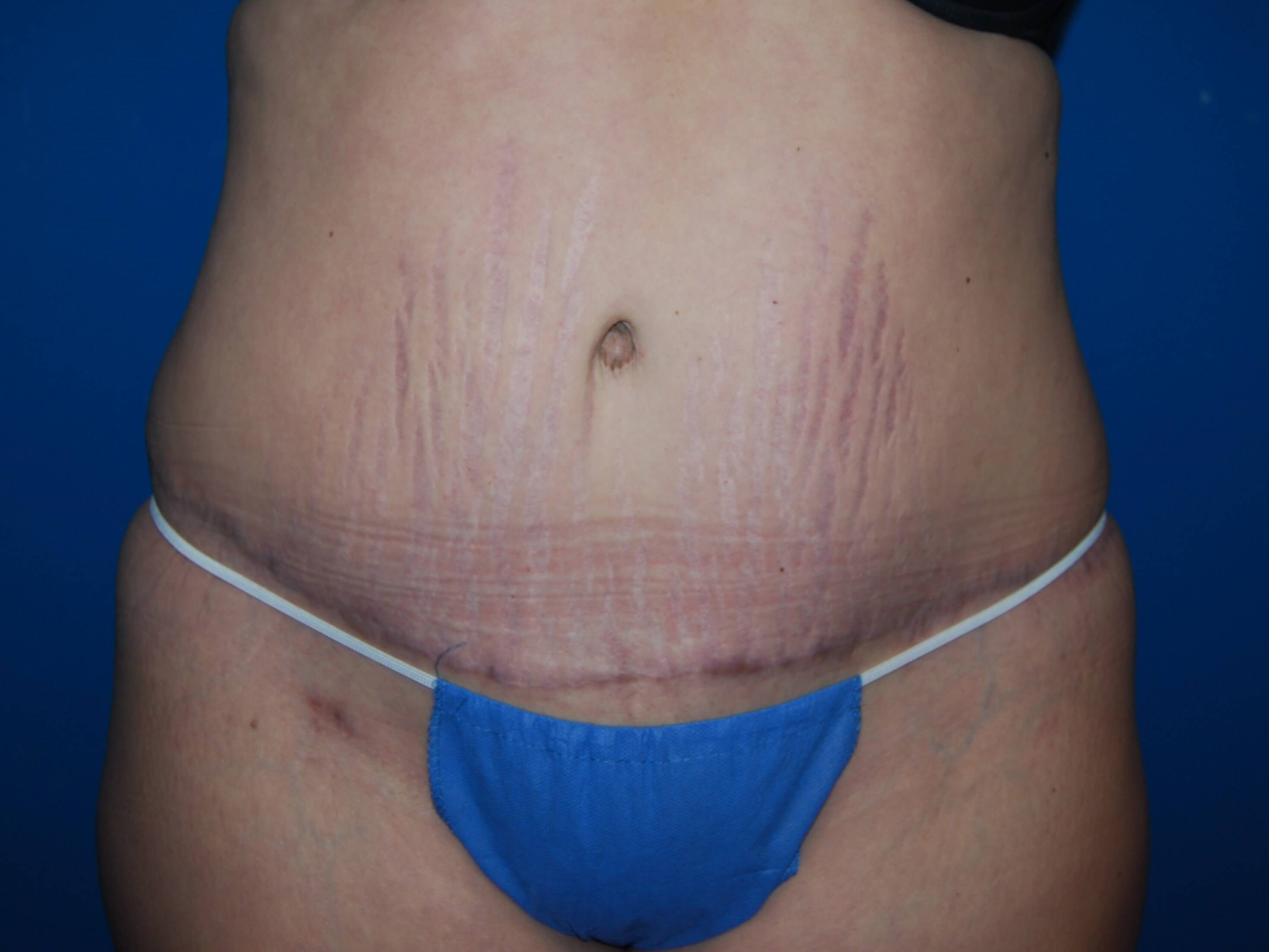Tummy Tuck - Front After