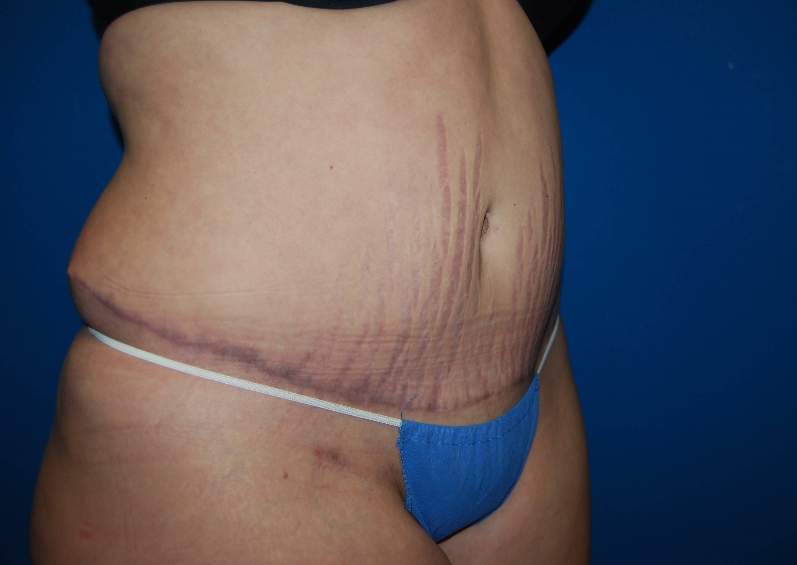 Tummy Tuck- Side After