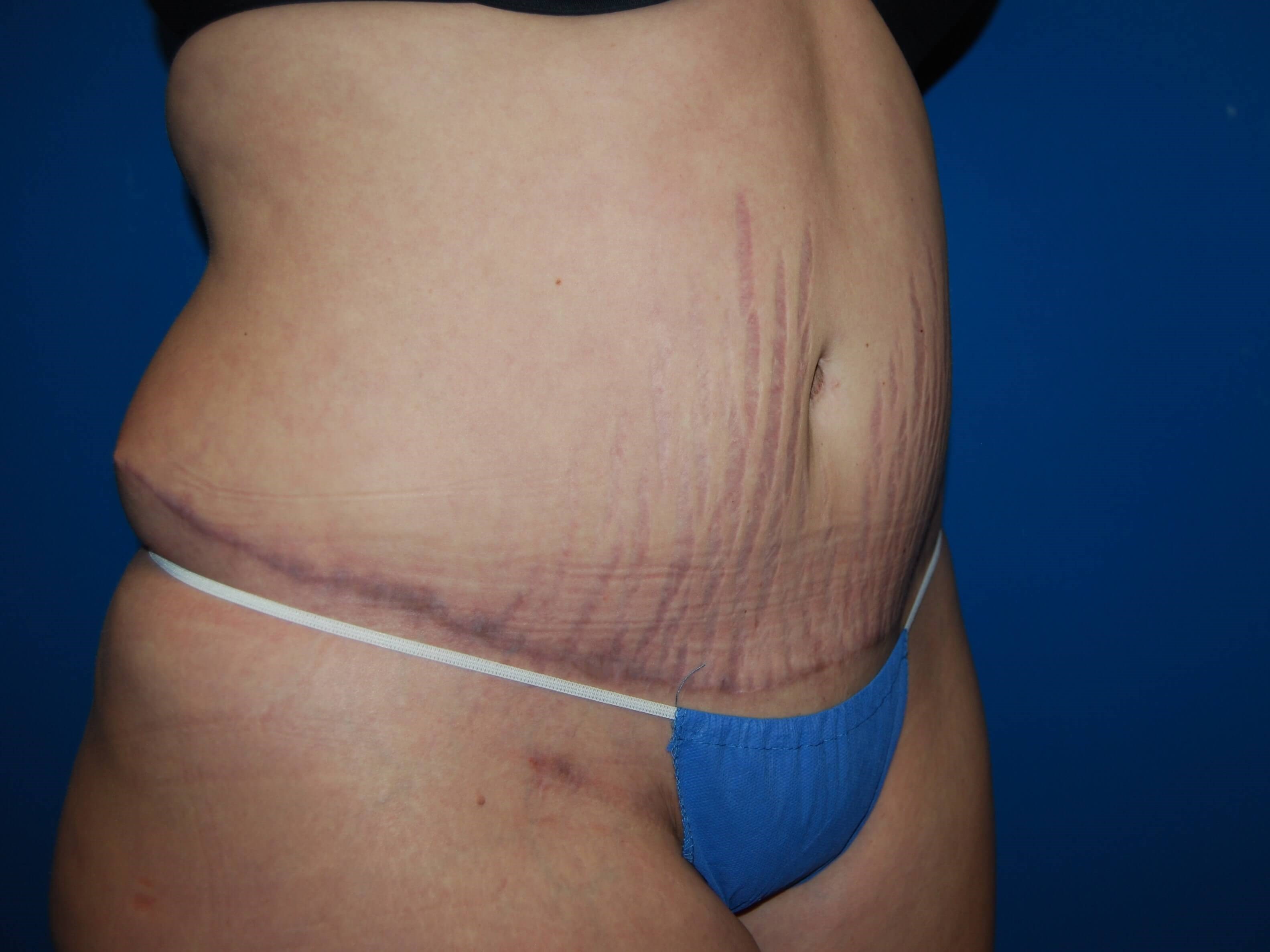 Tummy Tuck- Side After