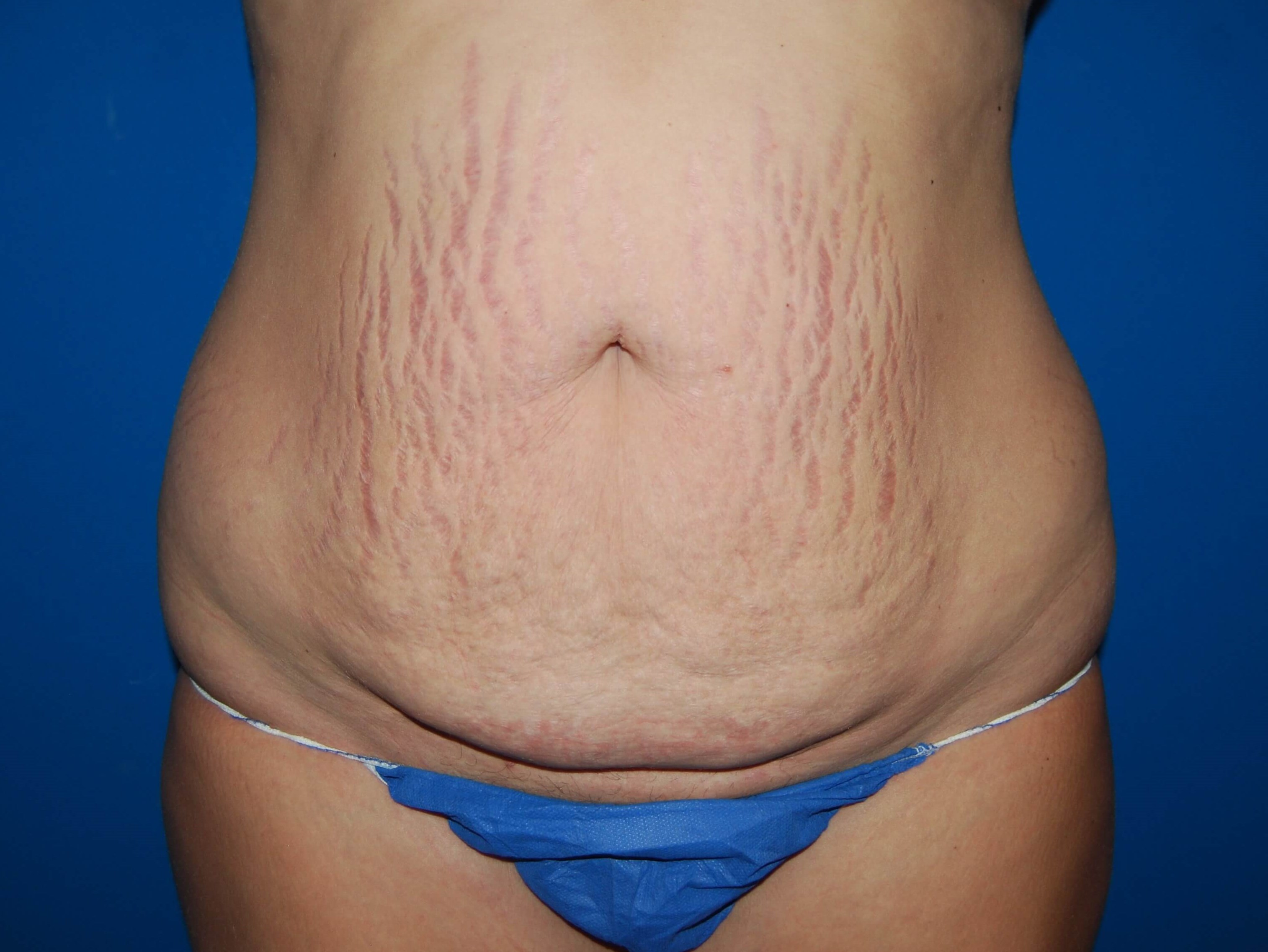 Tummy Tuck - Front Before