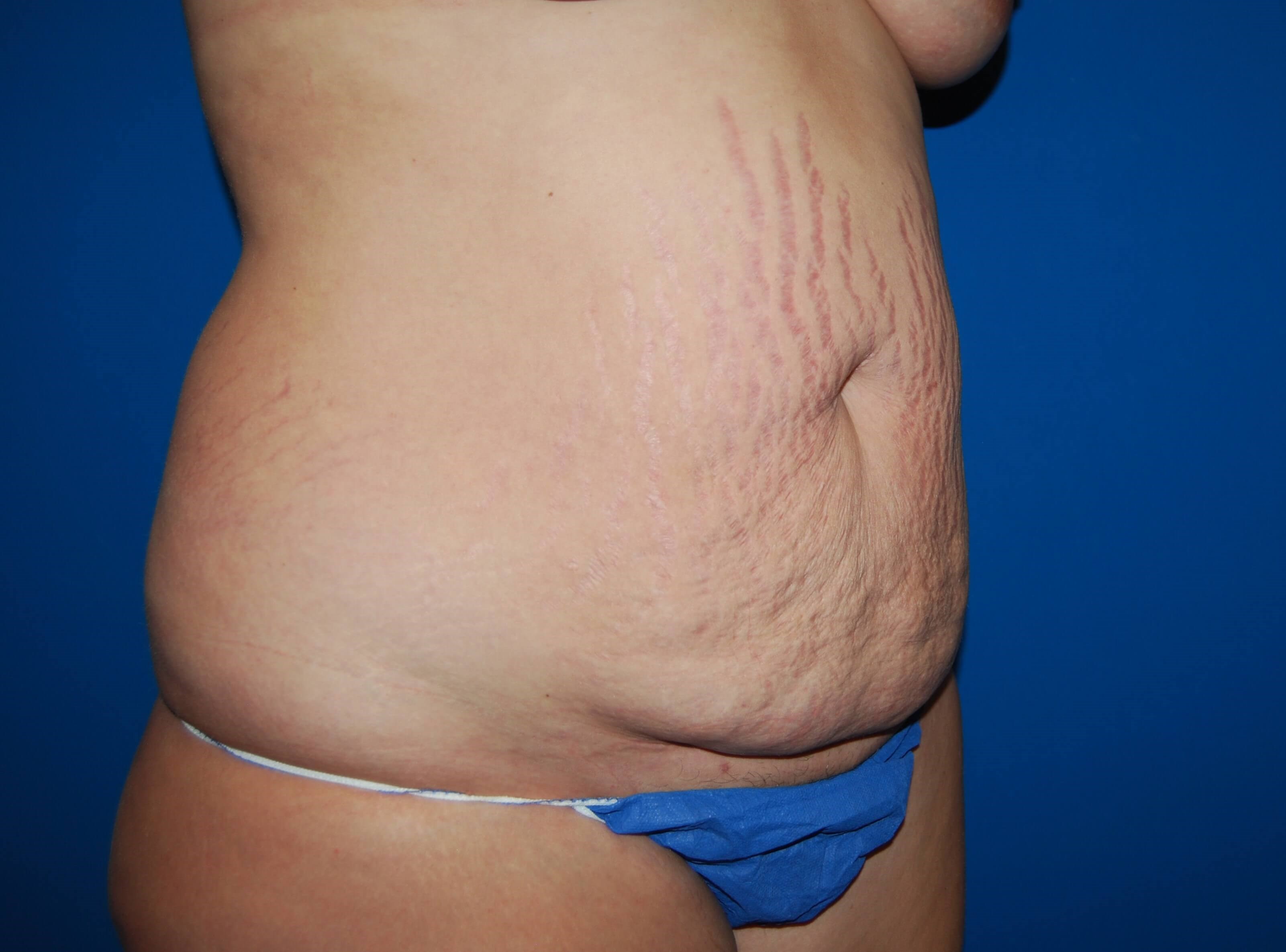 Tummy Tuck- Side Before