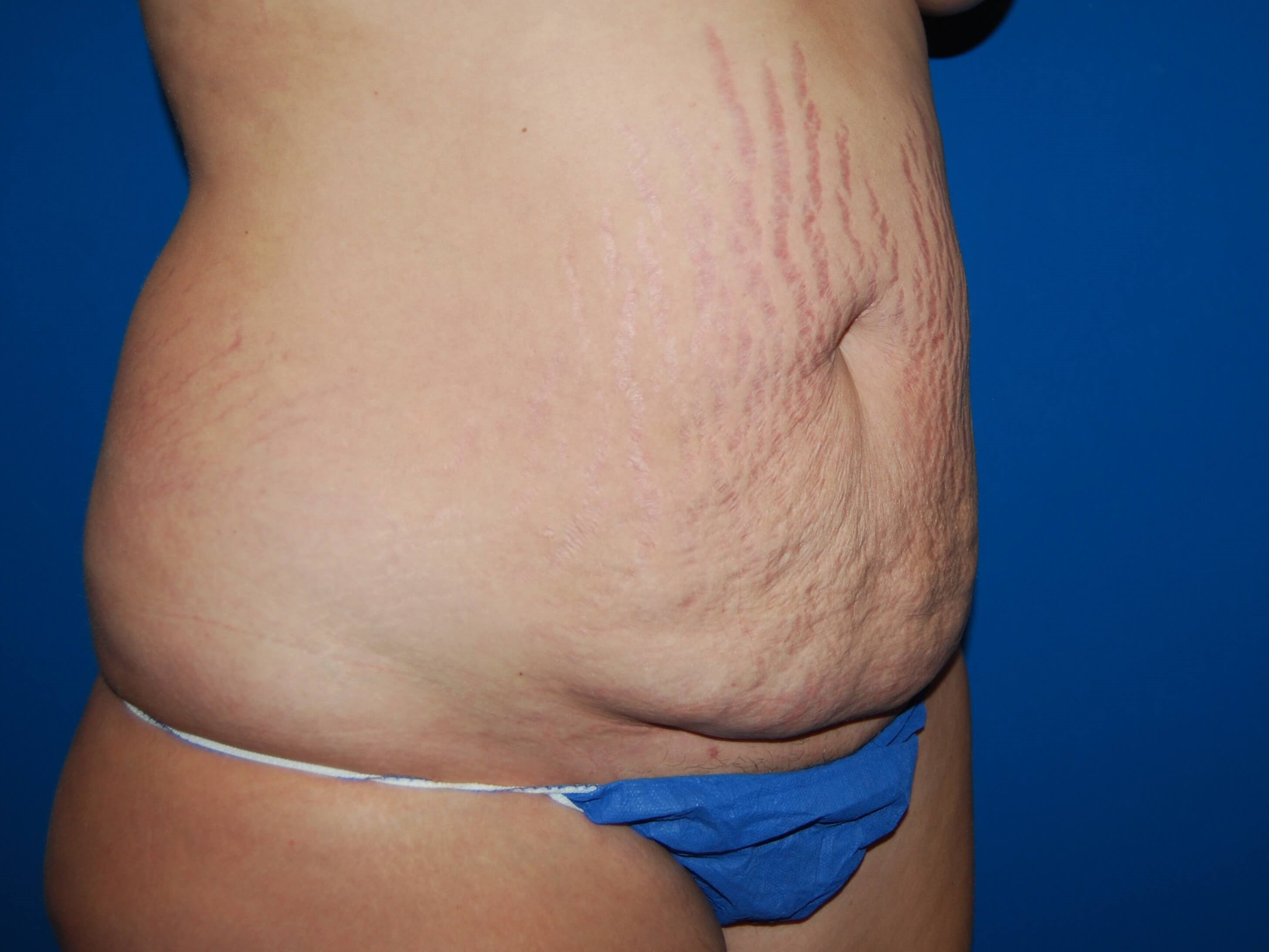 Tummy Tuck- Side Before