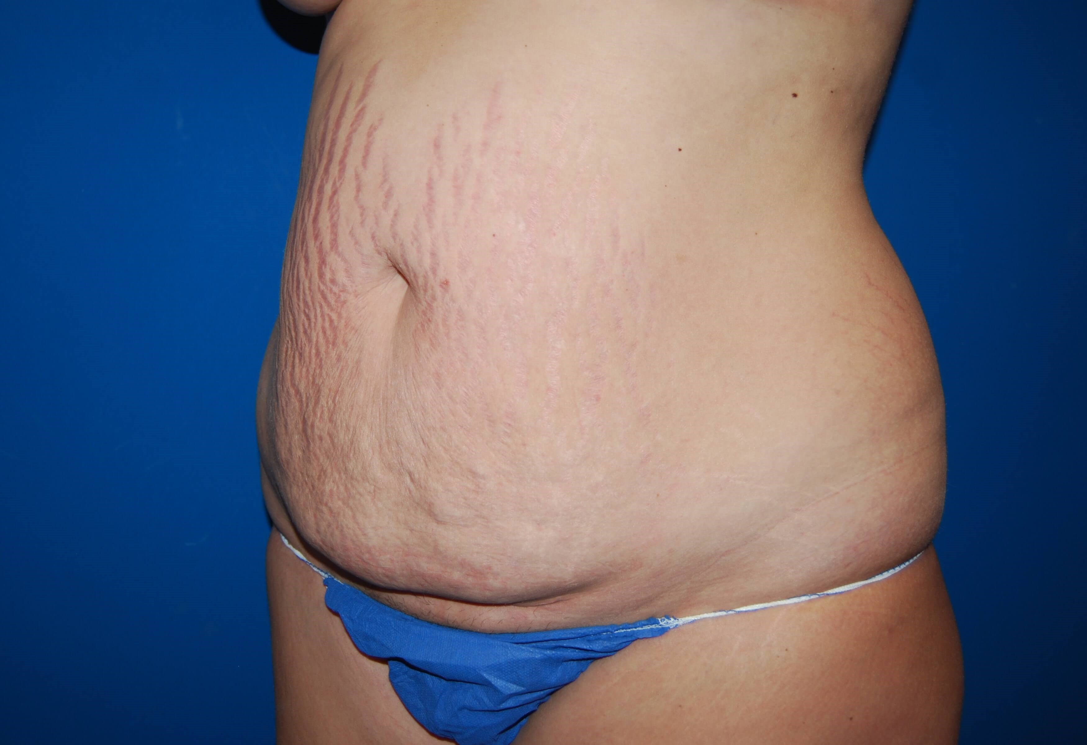 Tummy Tuck - Side Before