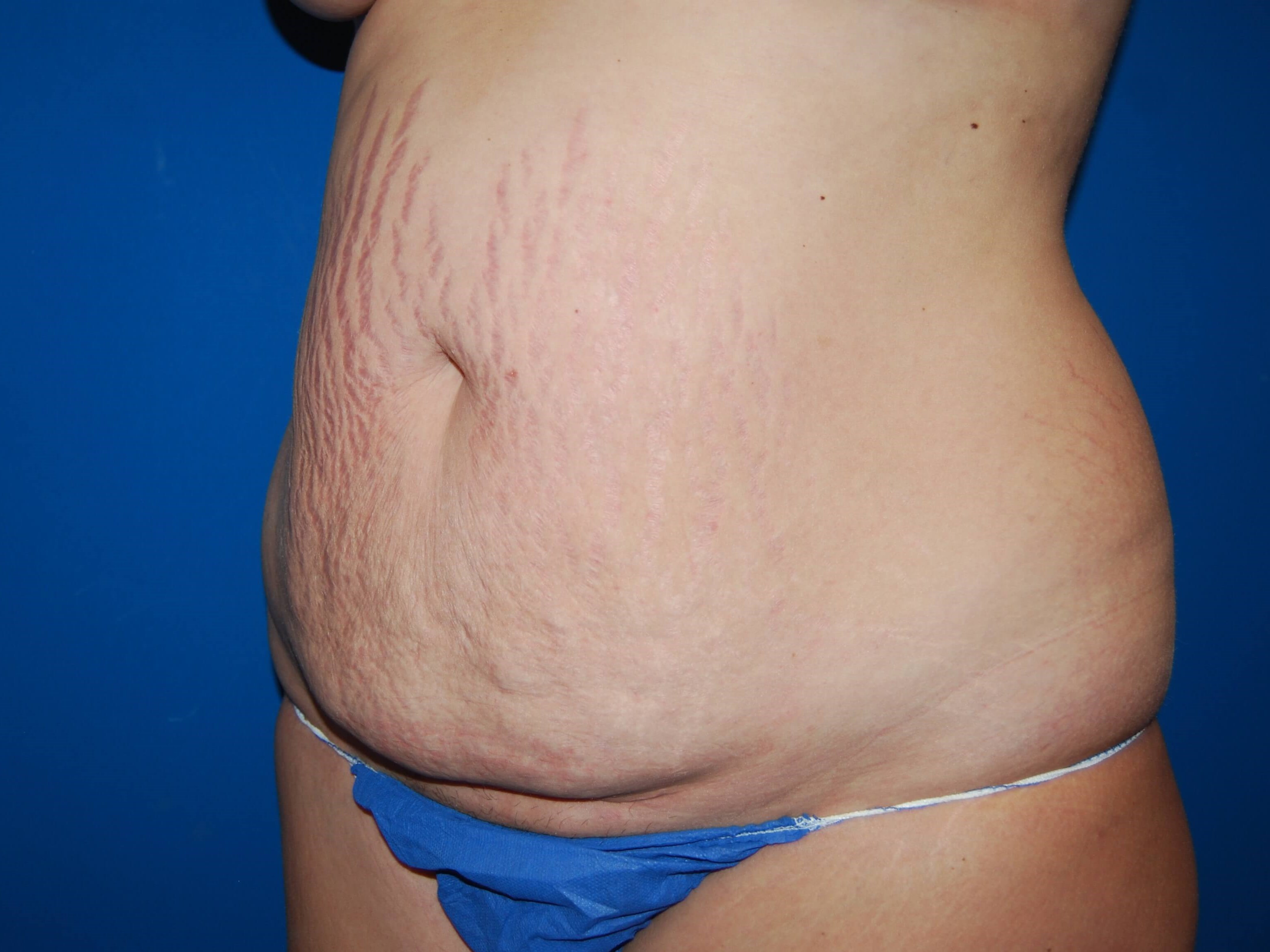 Tummy Tuck - Side Before