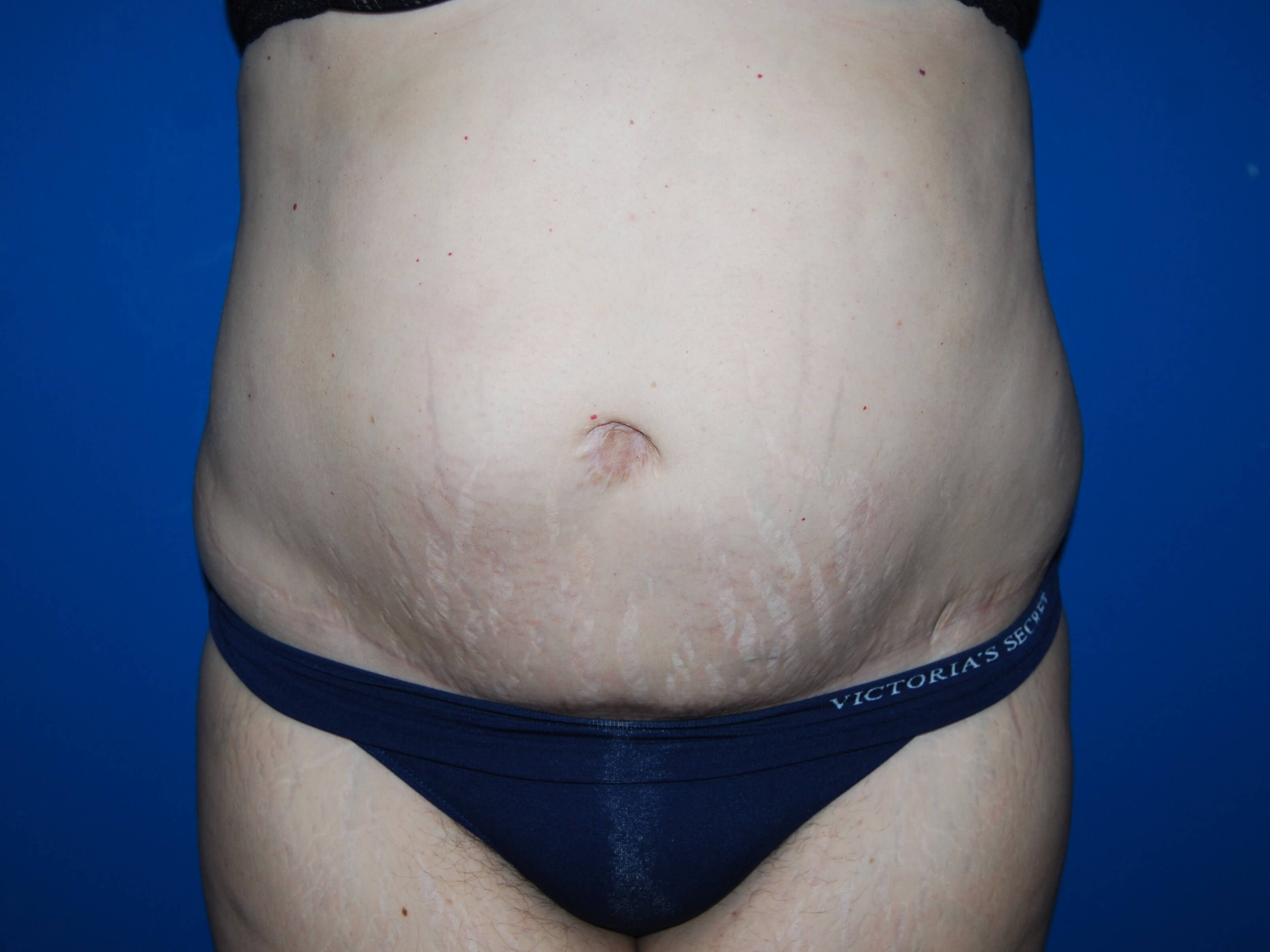 Extended Tummy Tuck - Front After