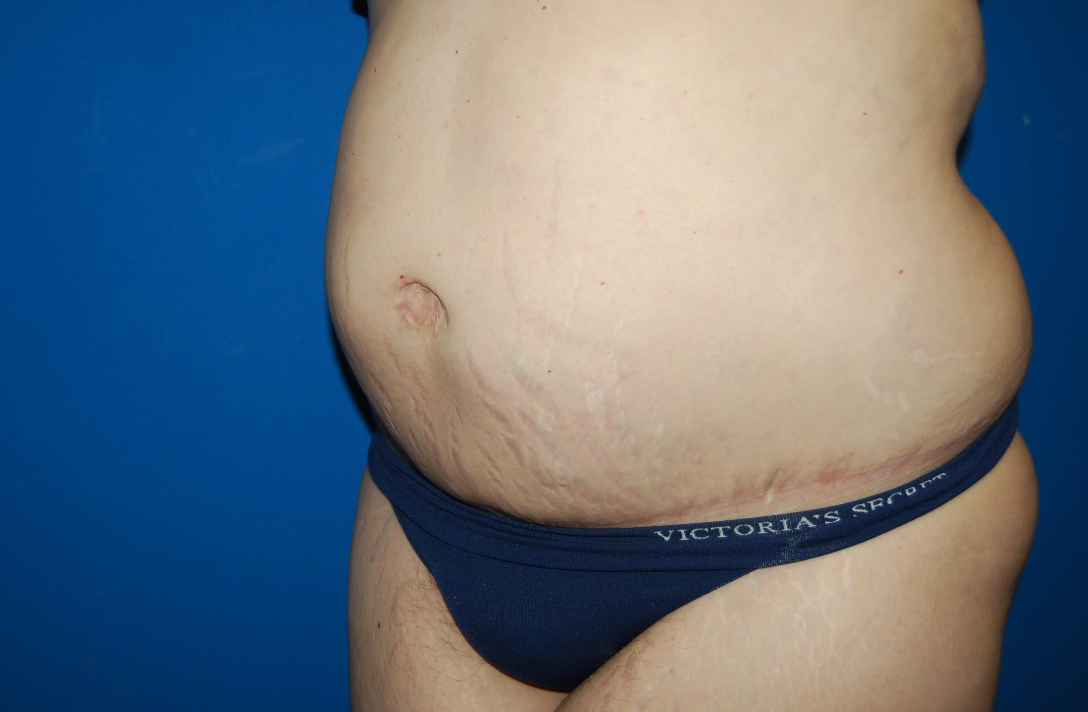 Extended Tummy Tuck - Left After