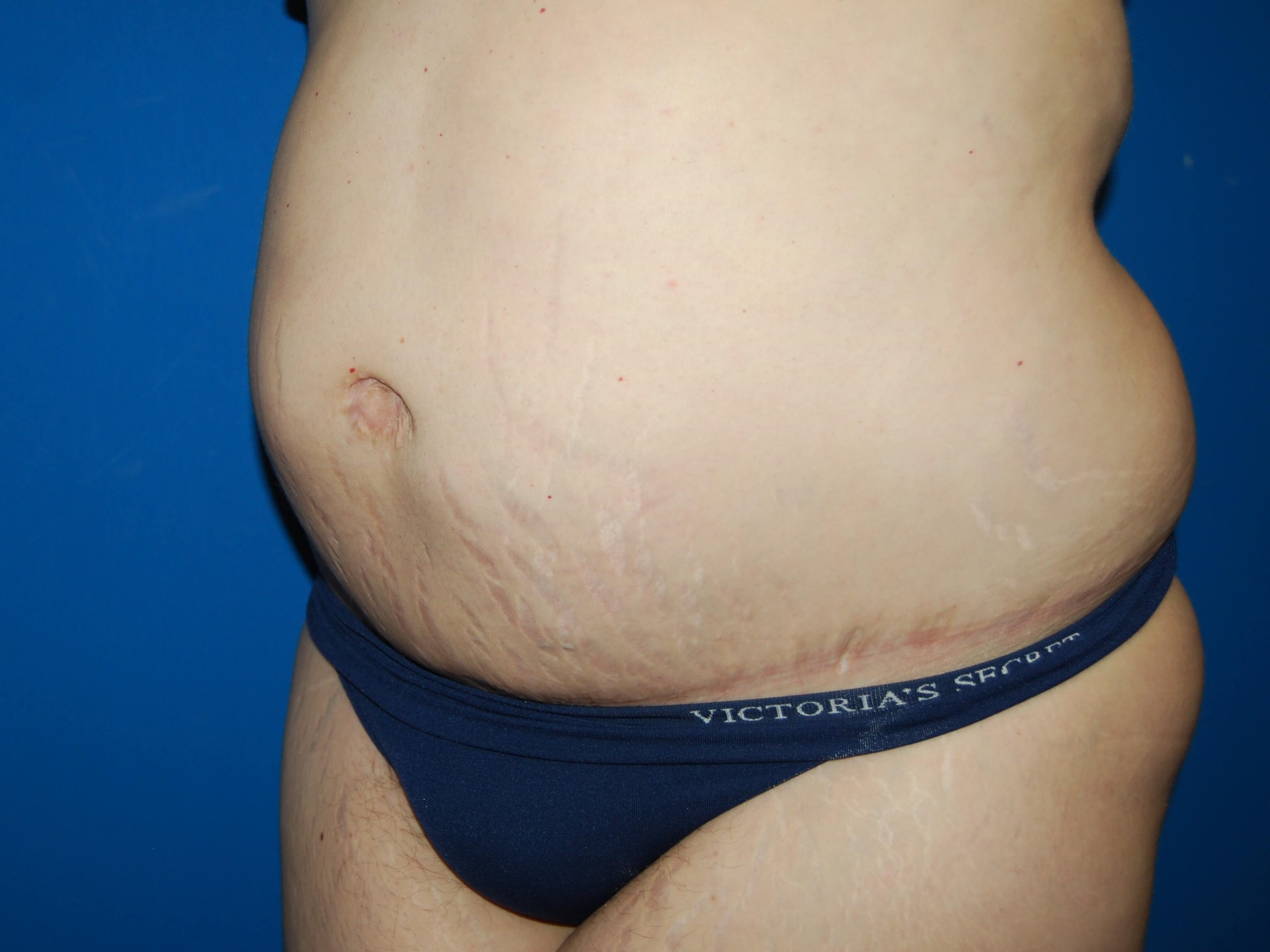 Extended Tummy Tuck - Left After
