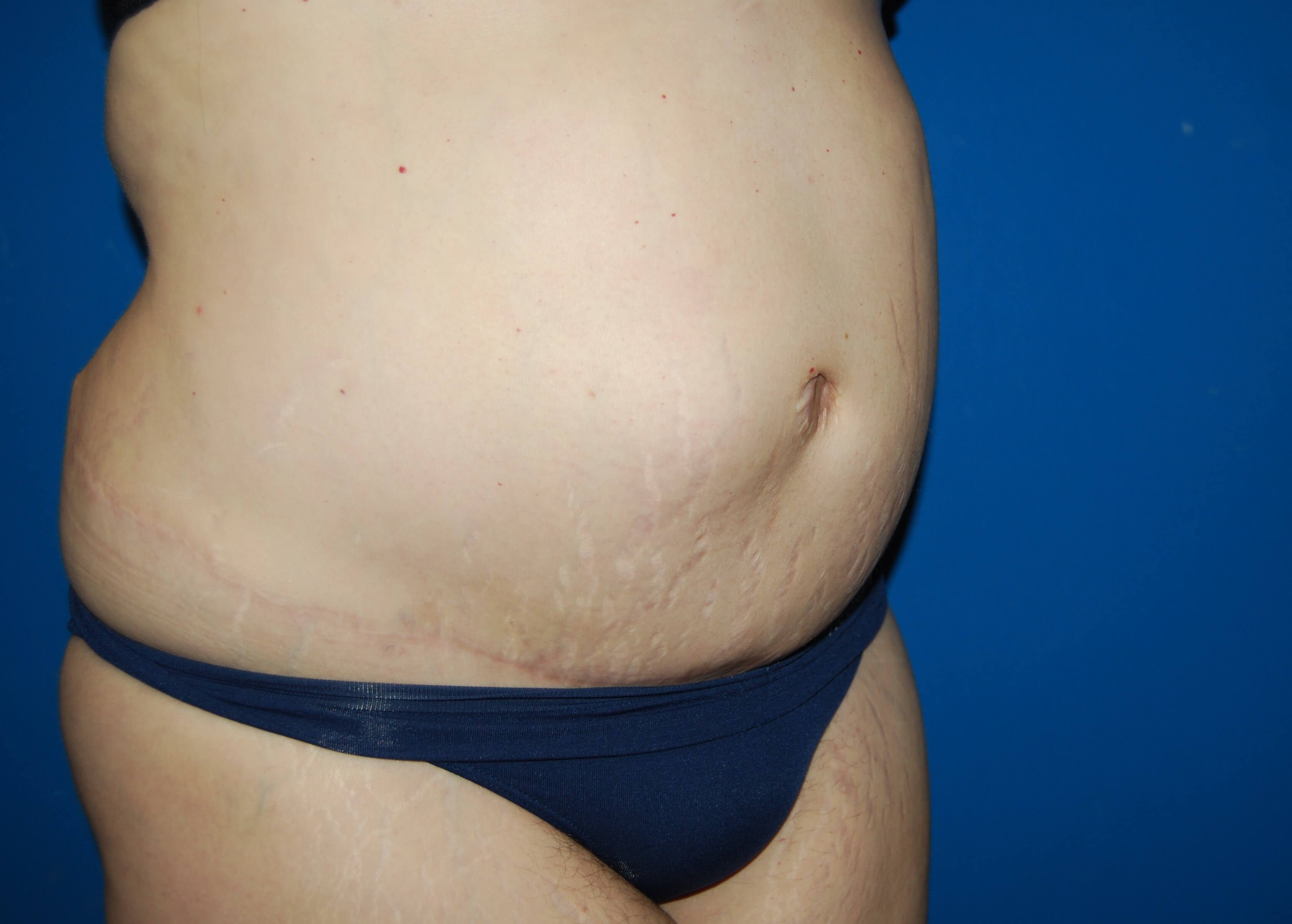 Extended Tummy Tuck - Right After