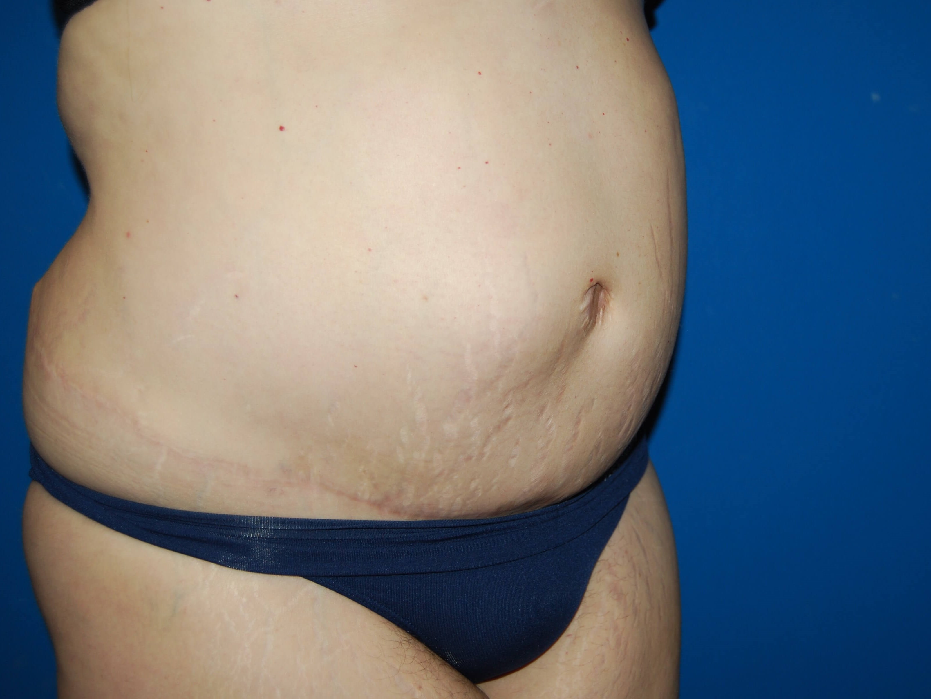Extended Tummy Tuck - Right After