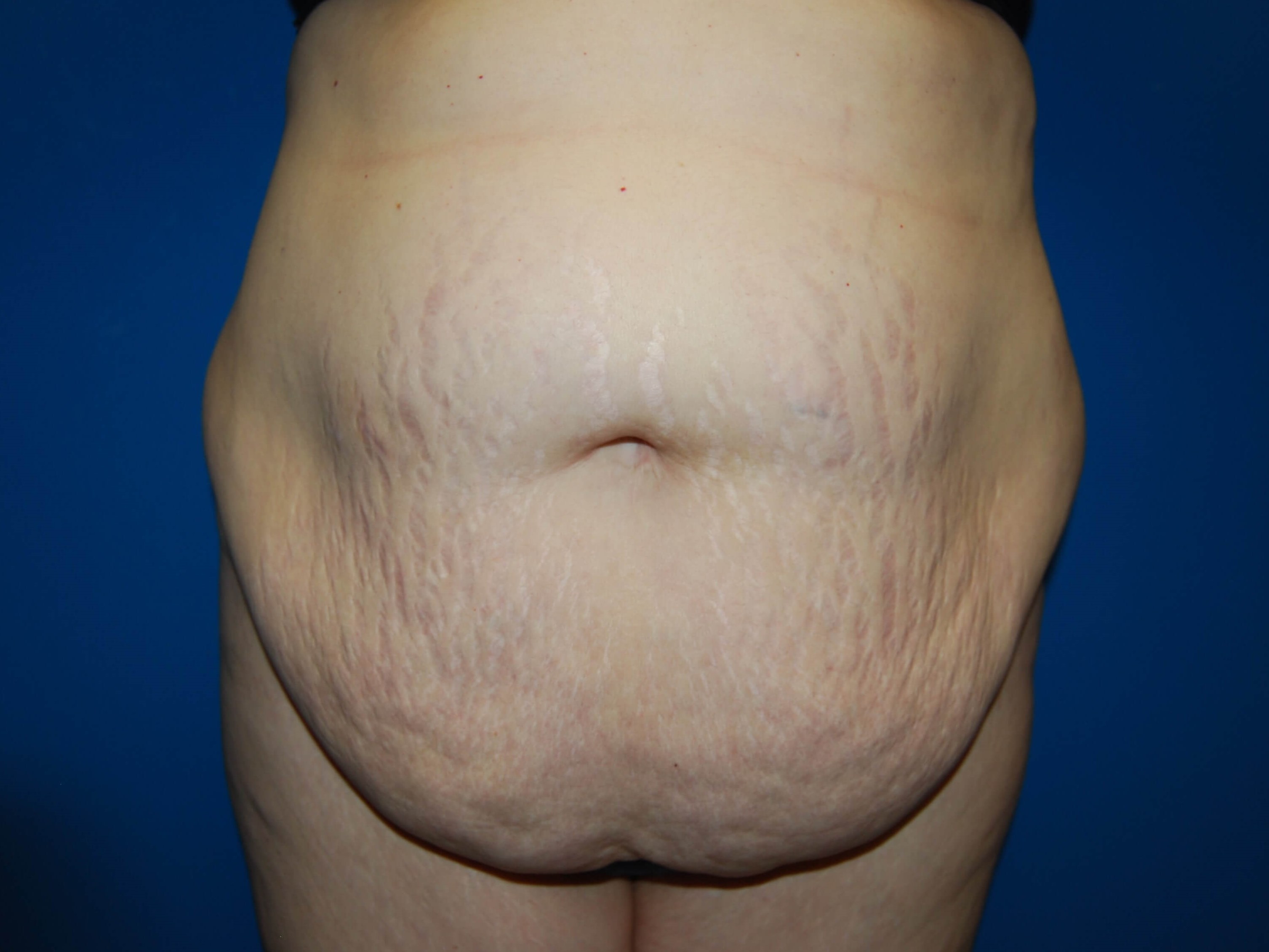 Extended Tummy Tuck - Front Before