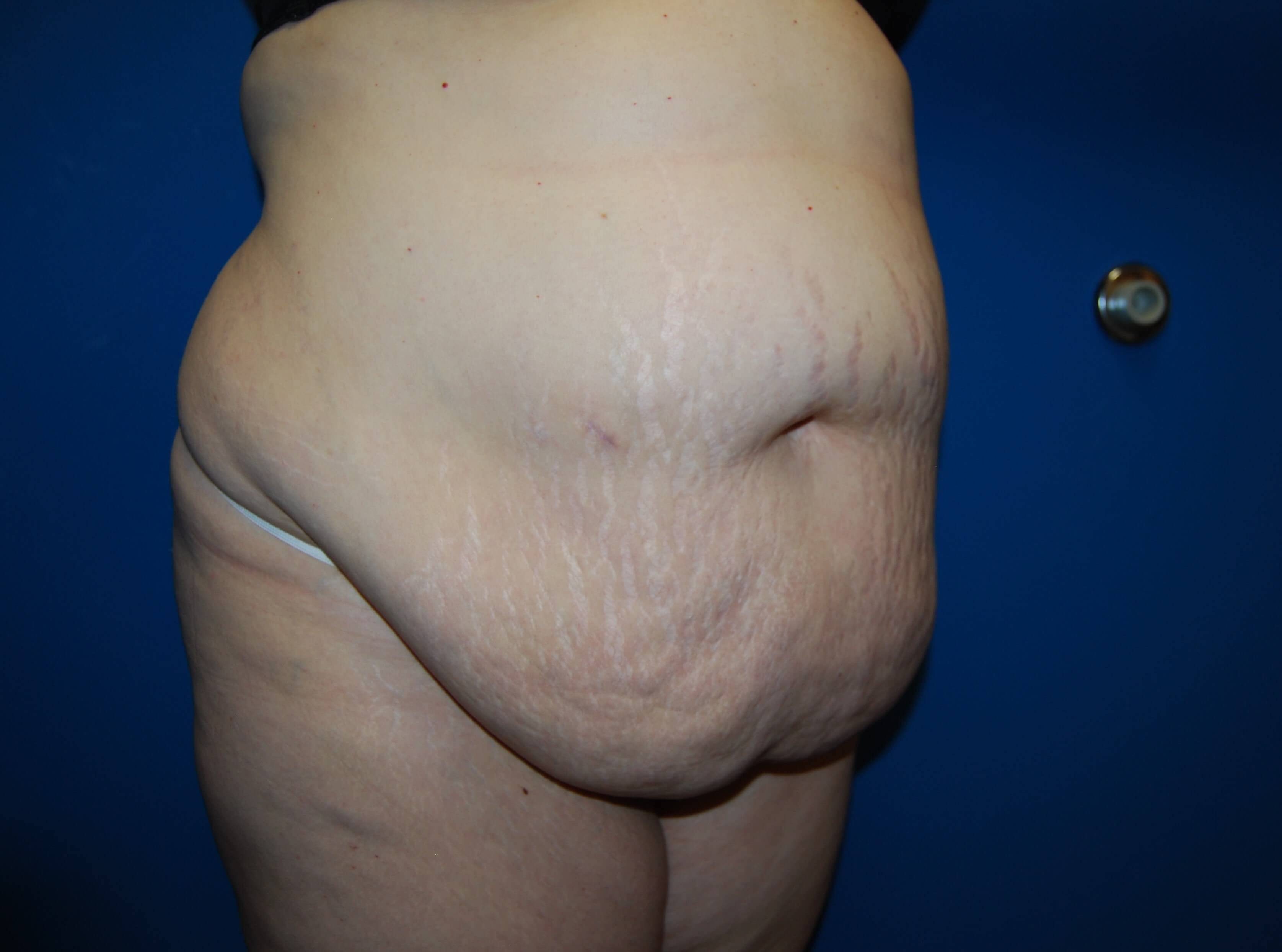 Extended Tummy Tuck - Right Before