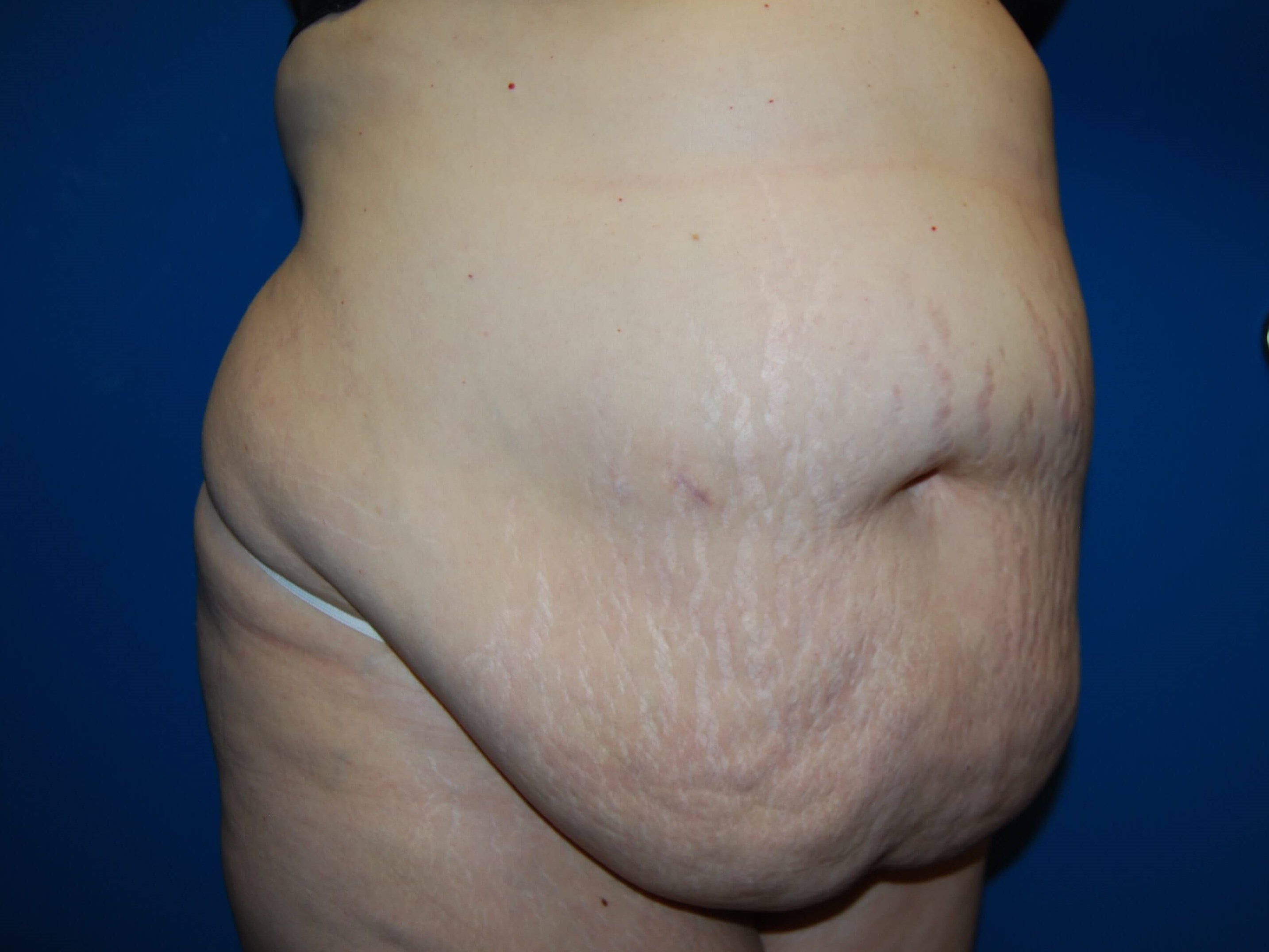 Extended Tummy Tuck - Right Before