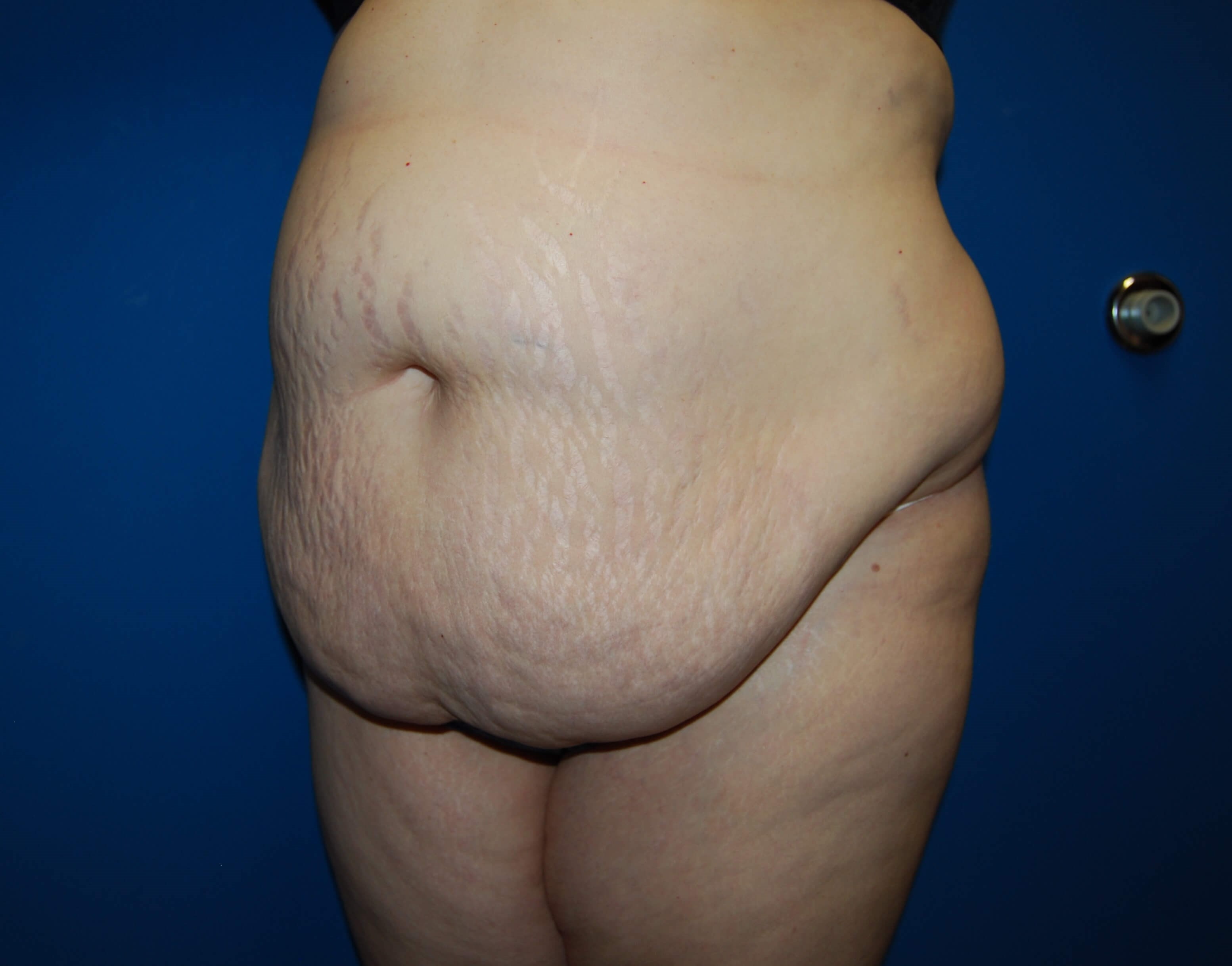 Extended Tummy Tuck - Left Before