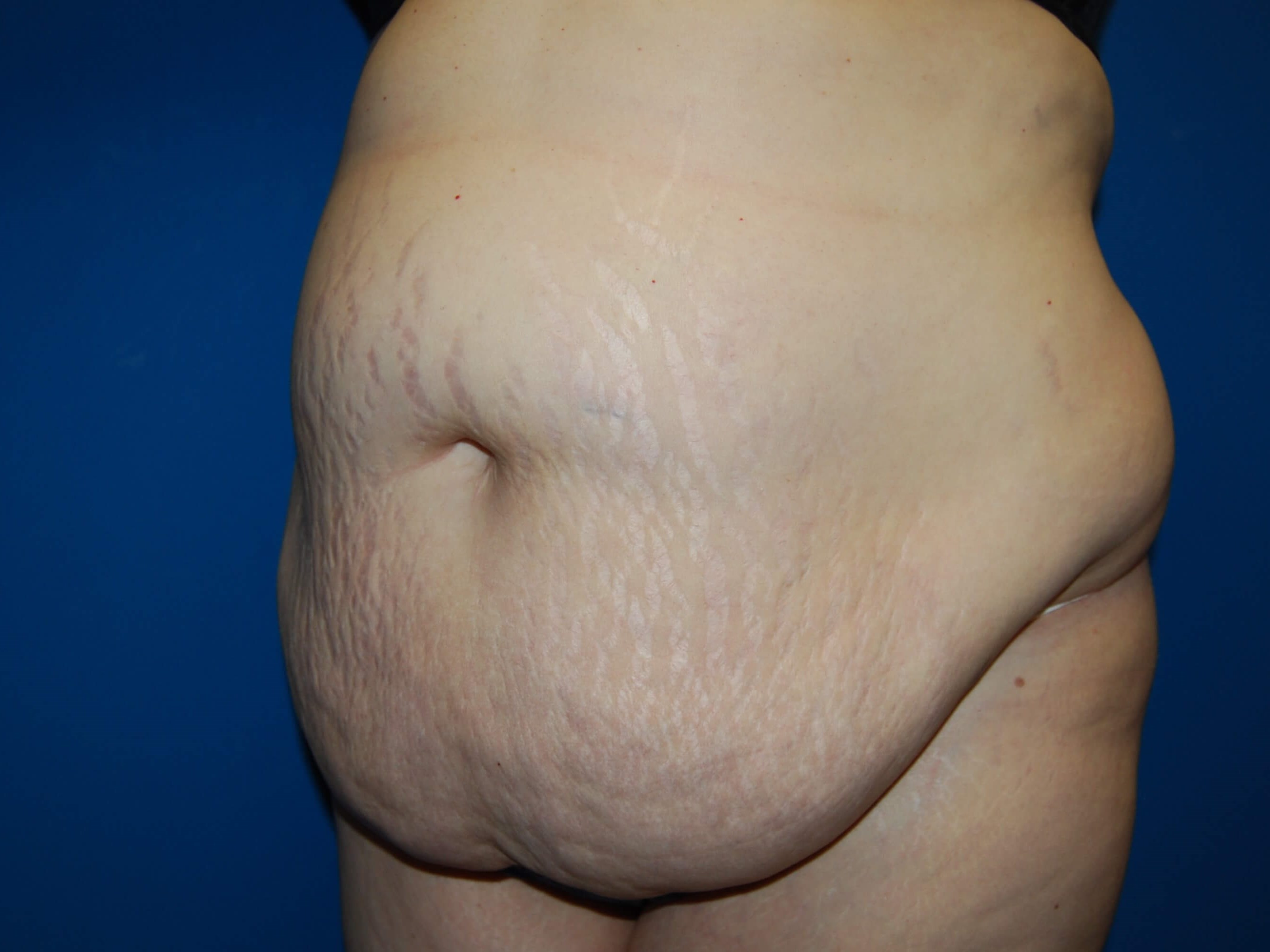 Extended Tummy Tuck - Left Before