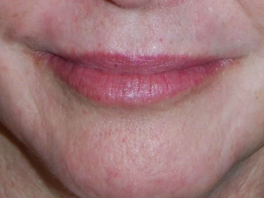 Perioral Laser Resurfacing After