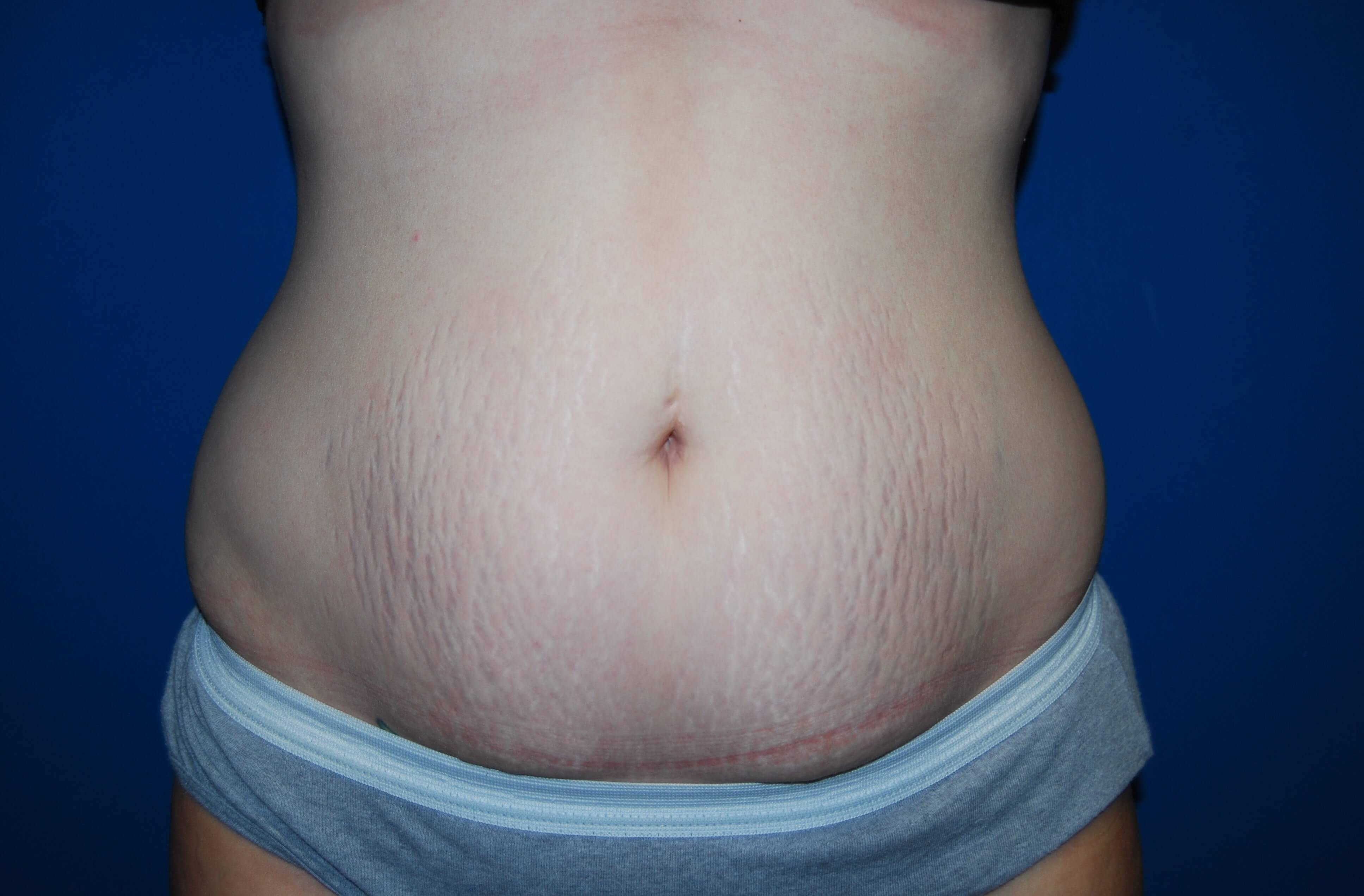 Tummy Tuck - Front Before