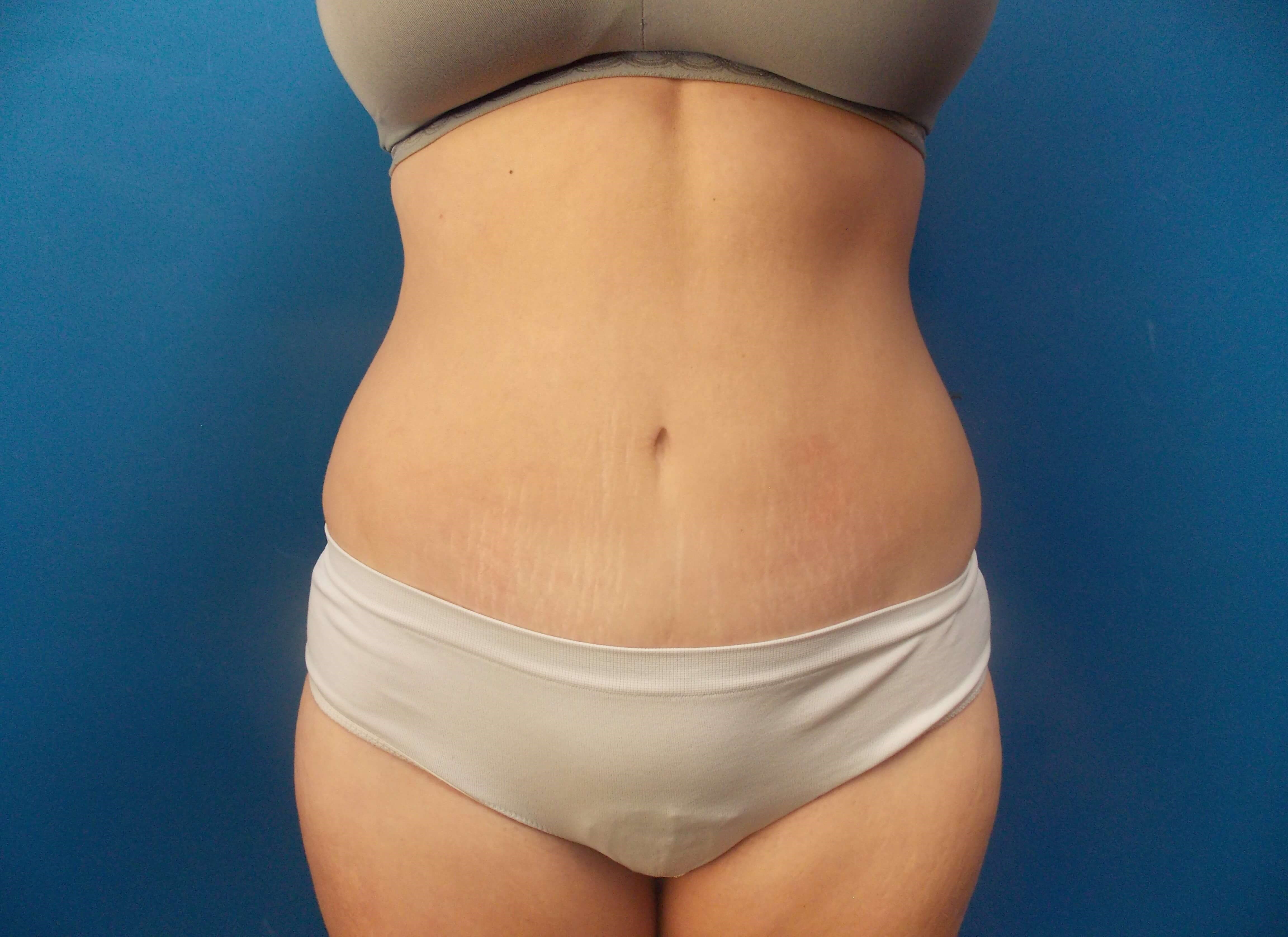 Tummy Tuck - Front After