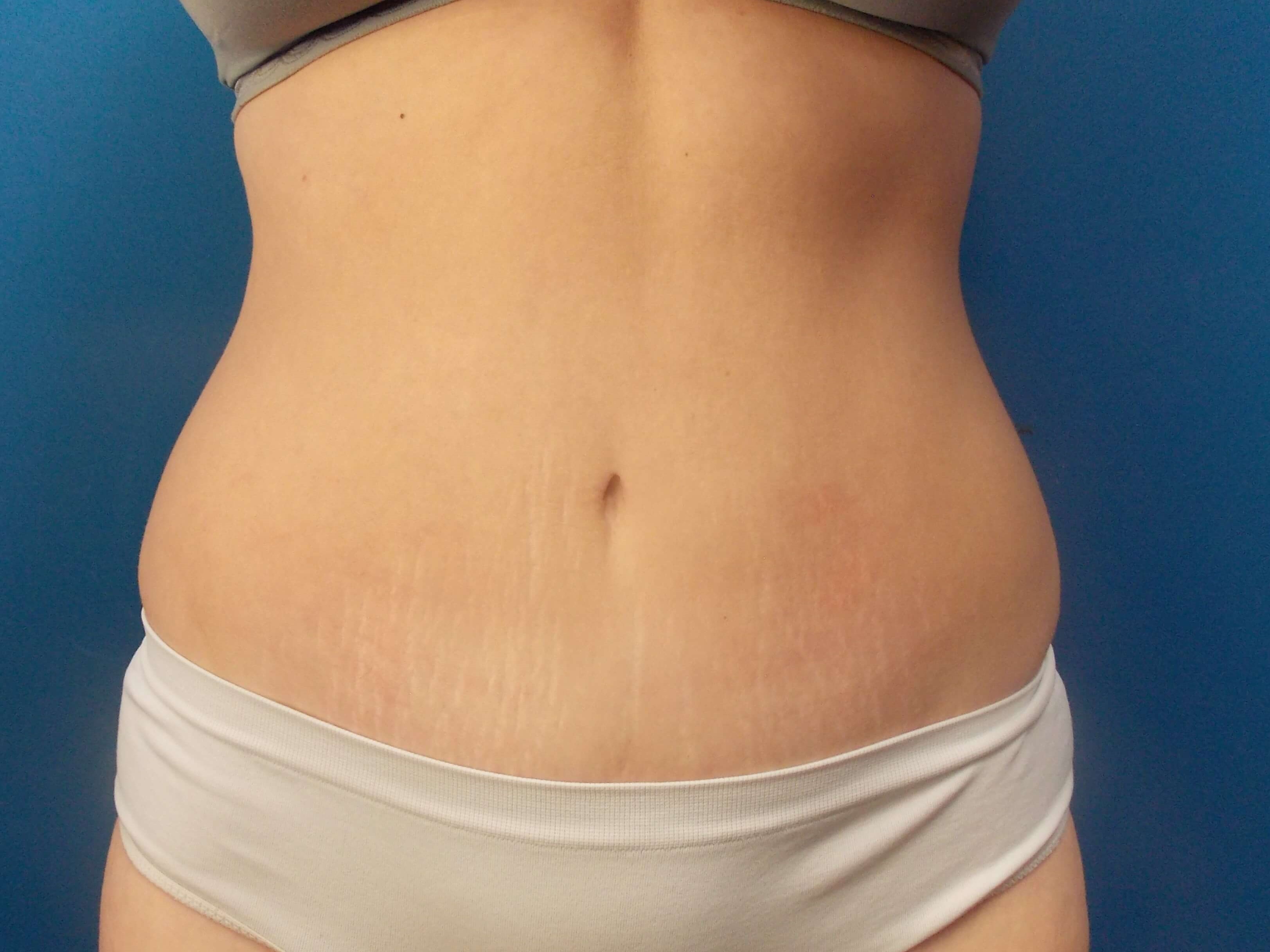 Tummy Tuck - Front After