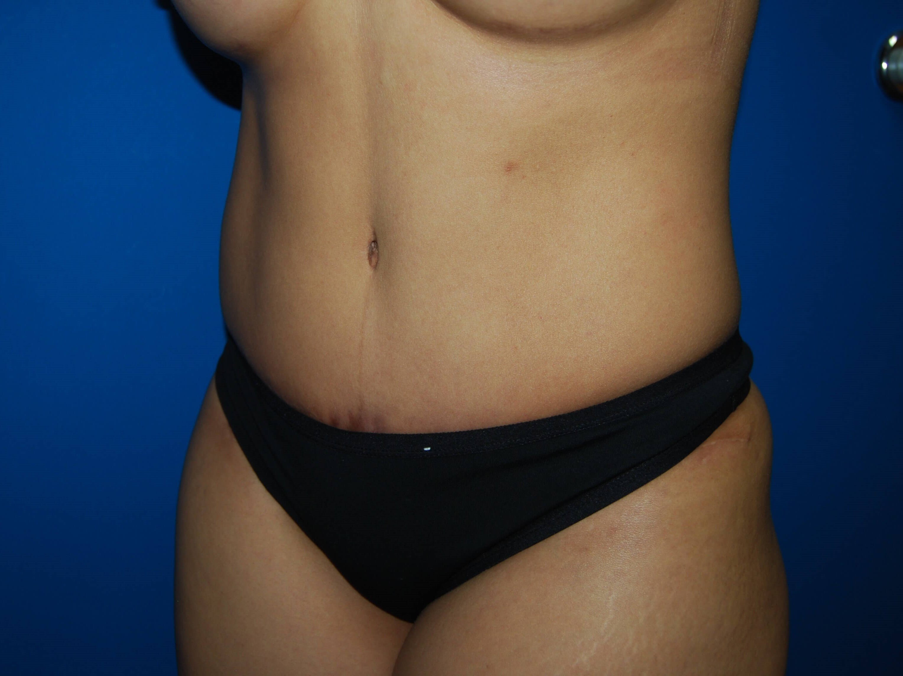 Tummy Tuck- Side After