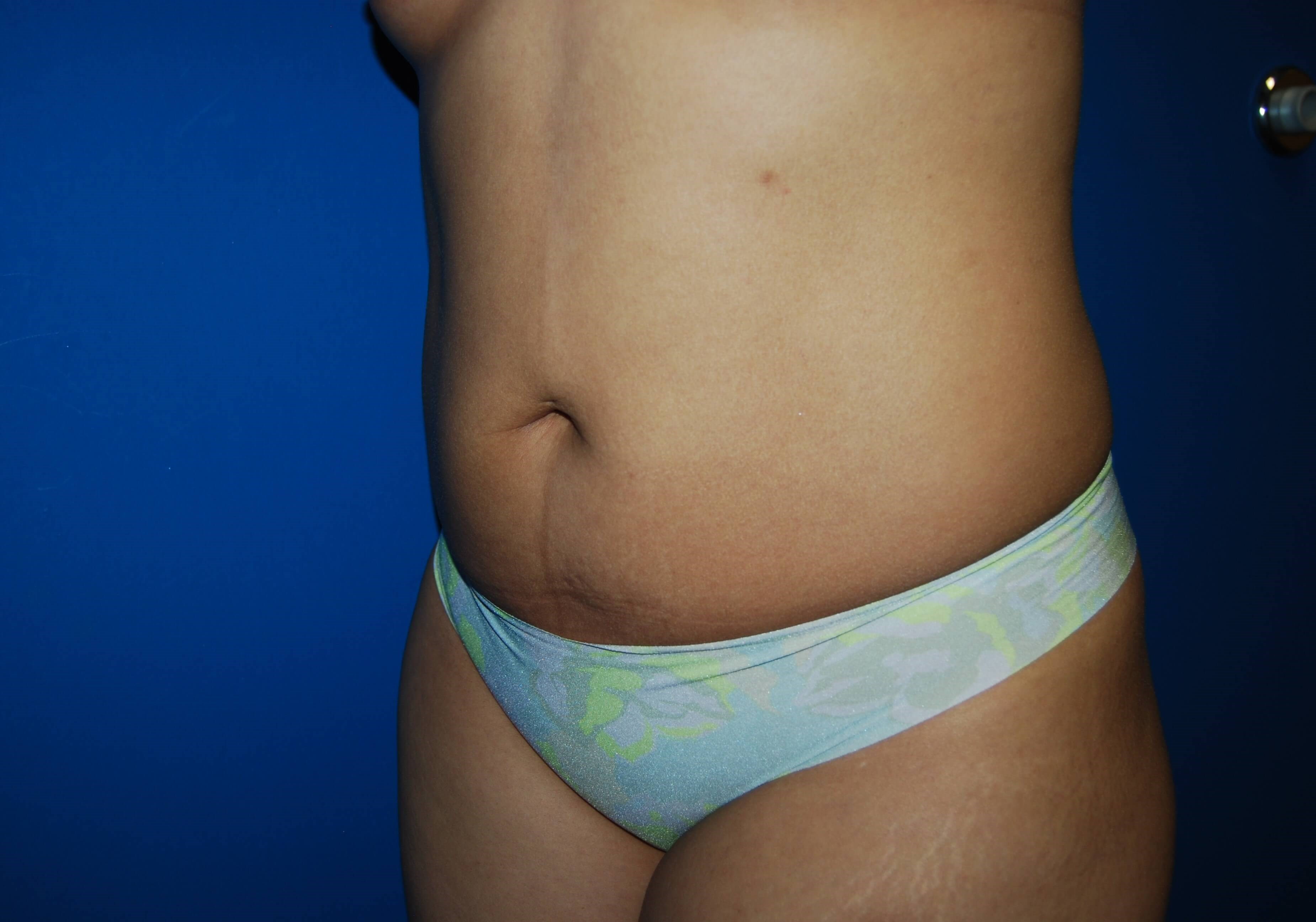 Tummy Tuck- Side Before