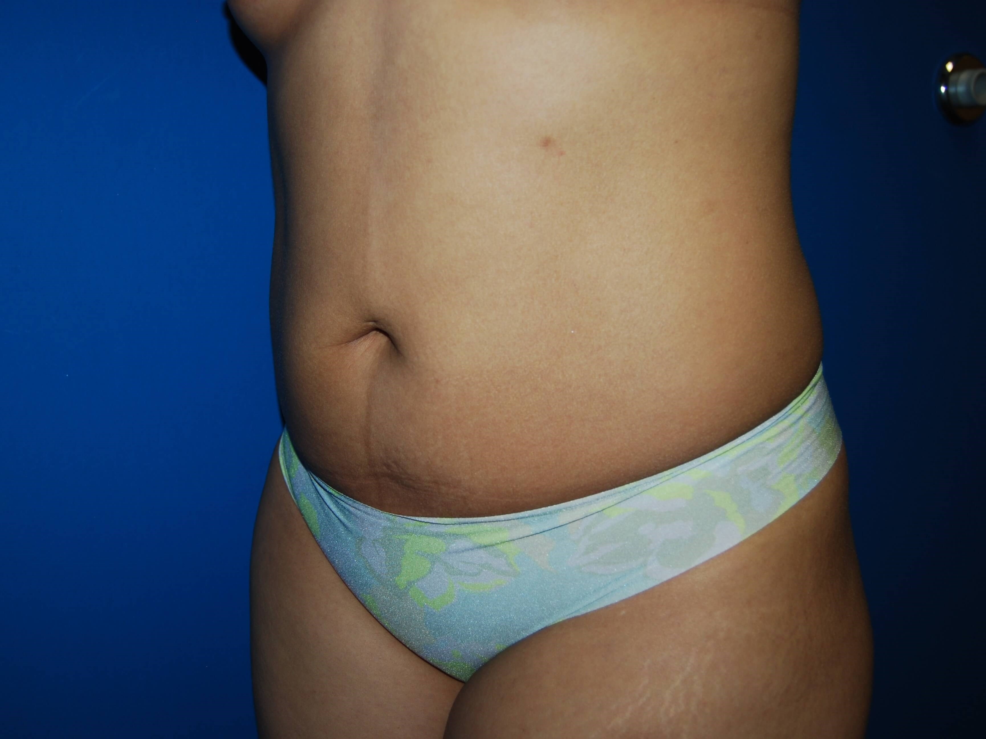 Tummy Tuck- Side Before