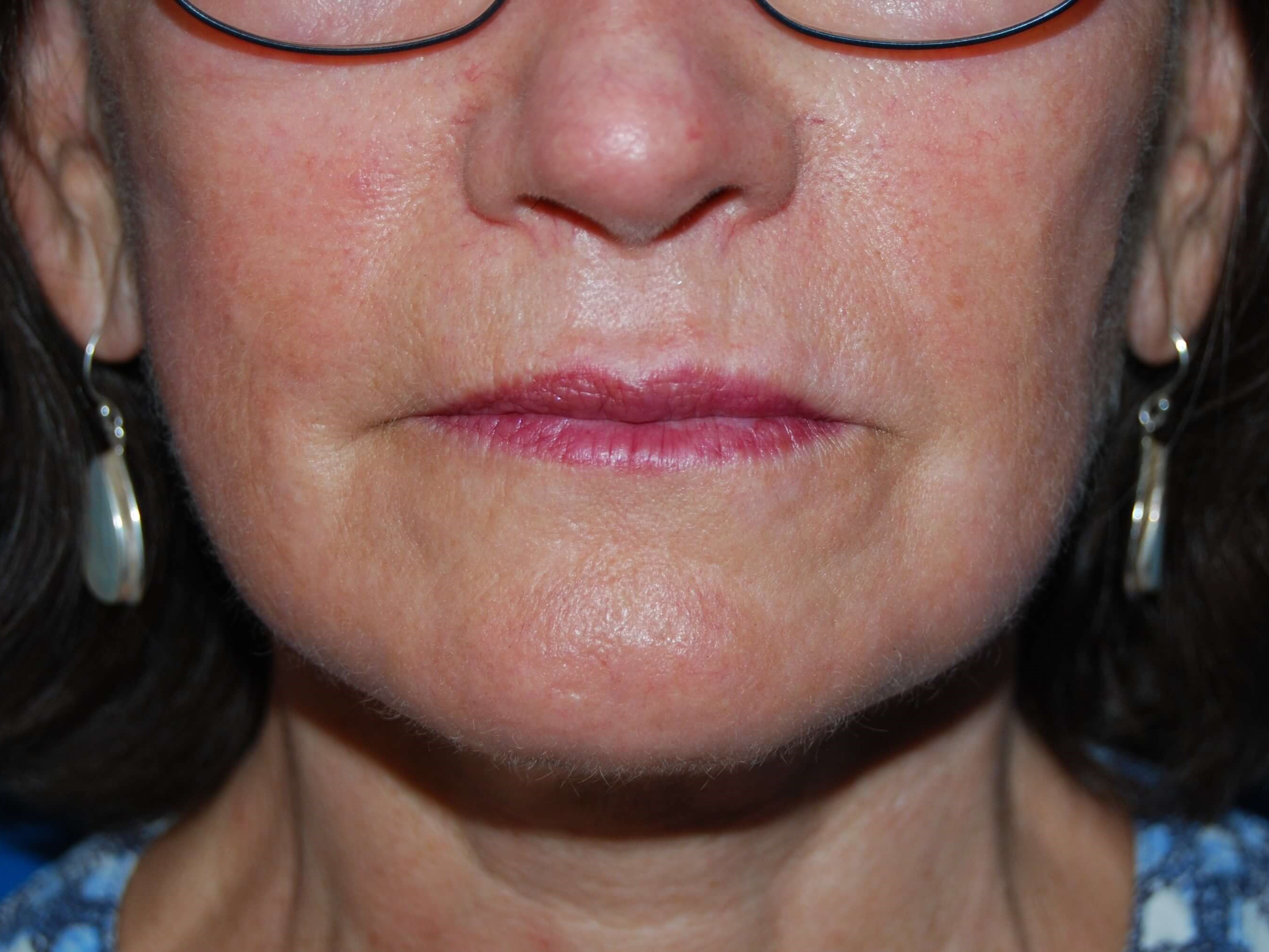 Perioral Laser Resurfacing After