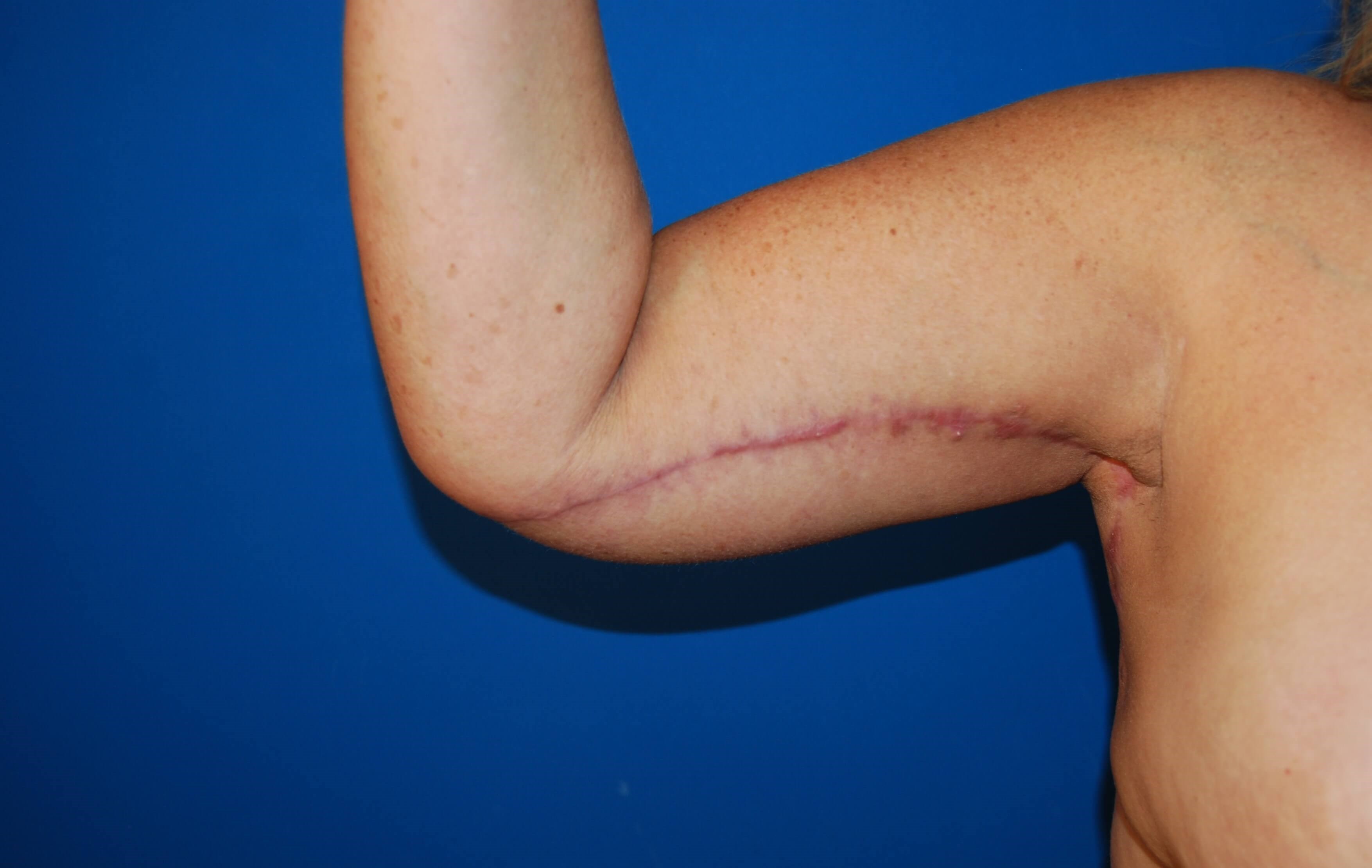 Inner Arm- Right 3 Months After Arm Lift