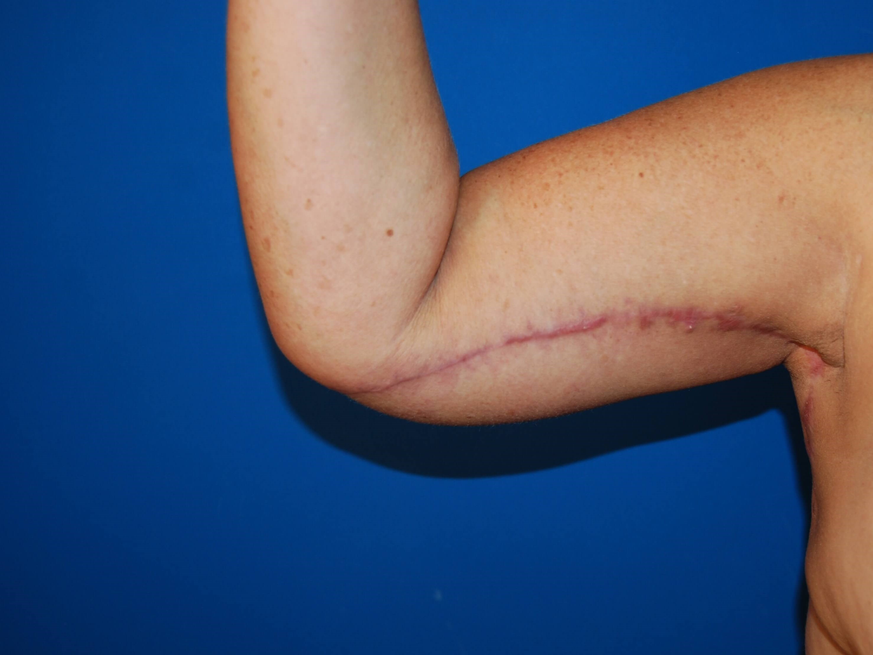 Inner Arm- Right 3 Months After Arm Lift