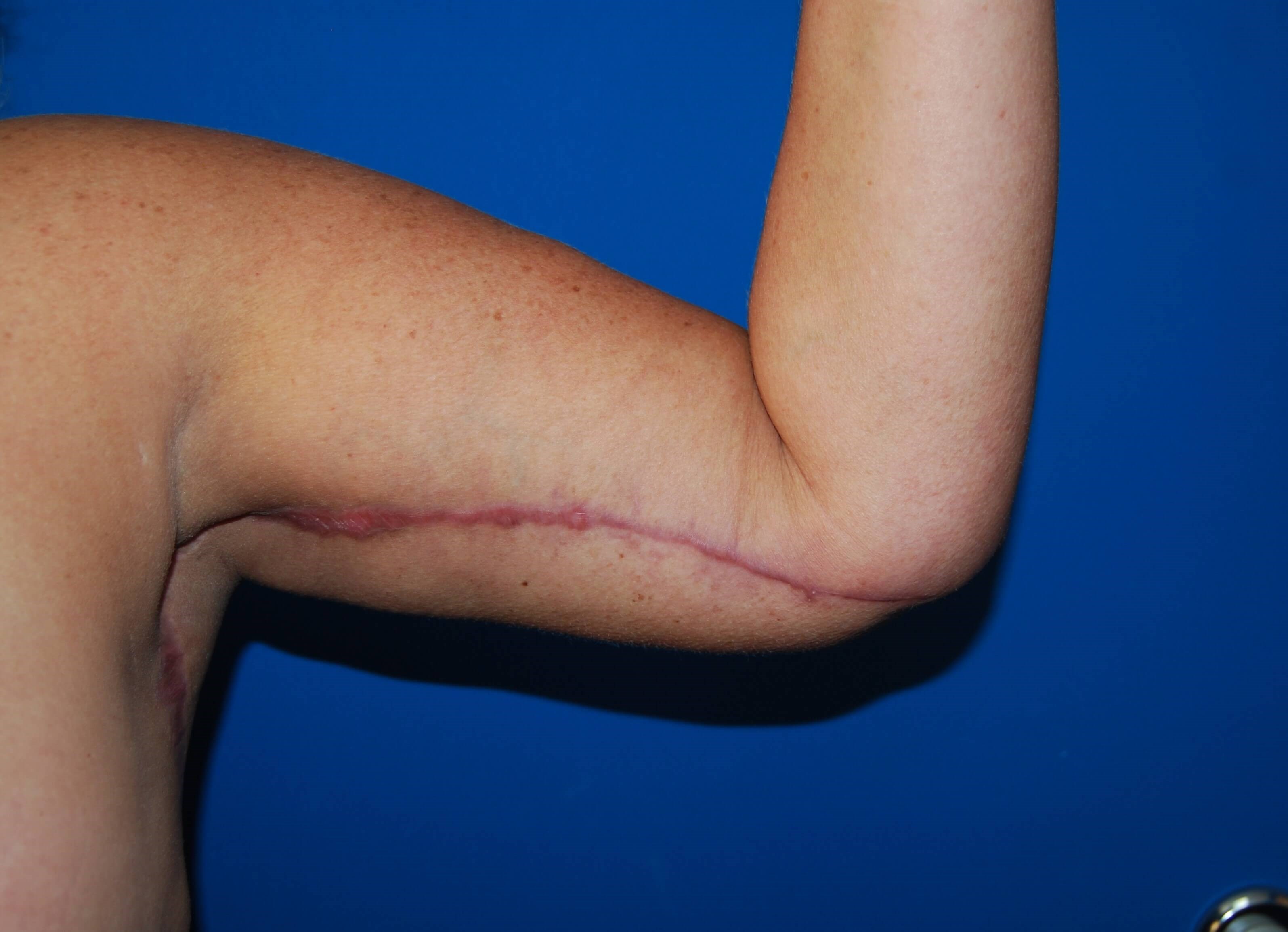 Inner Arm- Left 3 Months After Arm Lift
