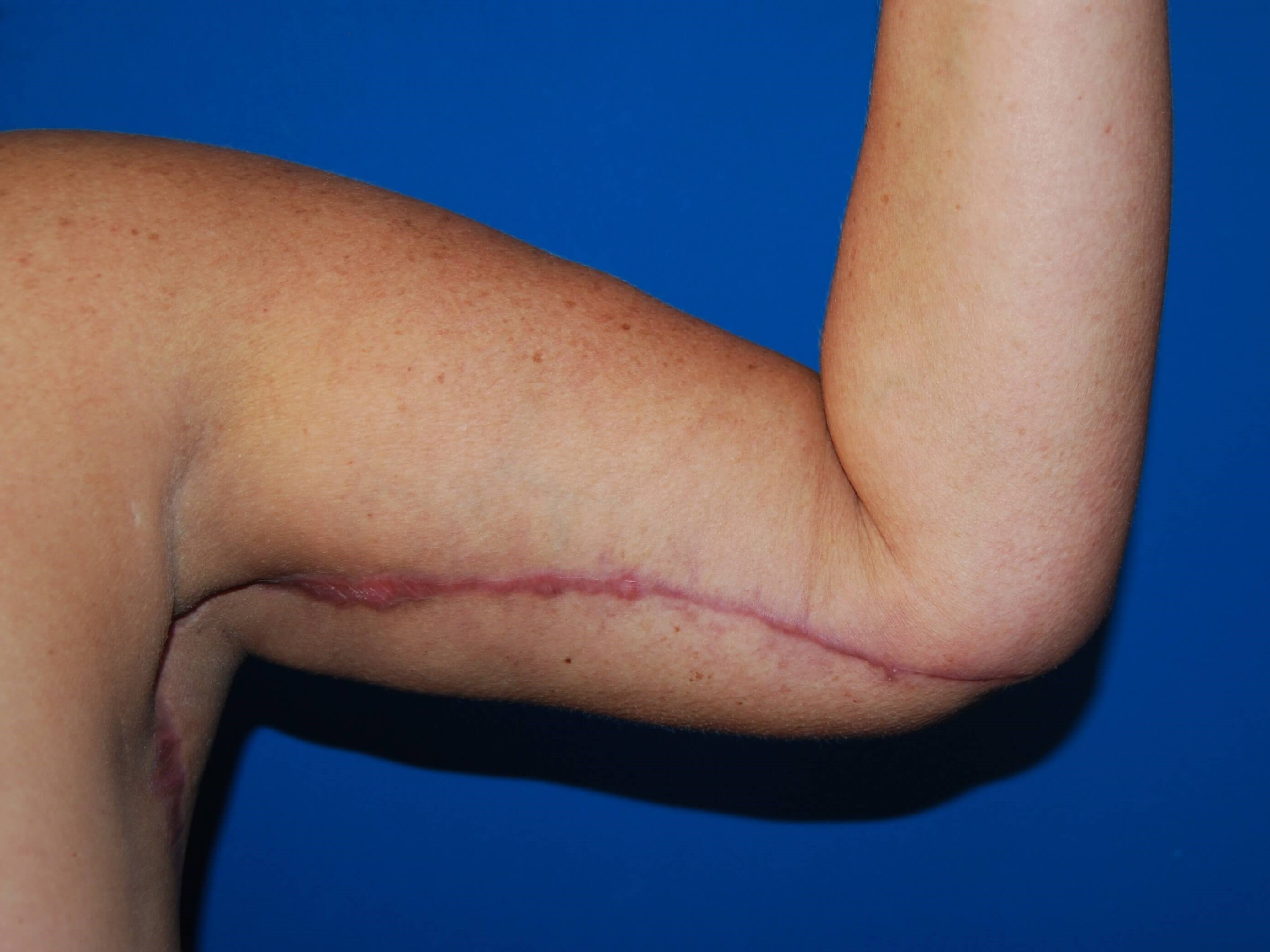 Inner Arm- Left 3 Months After Arm Lift