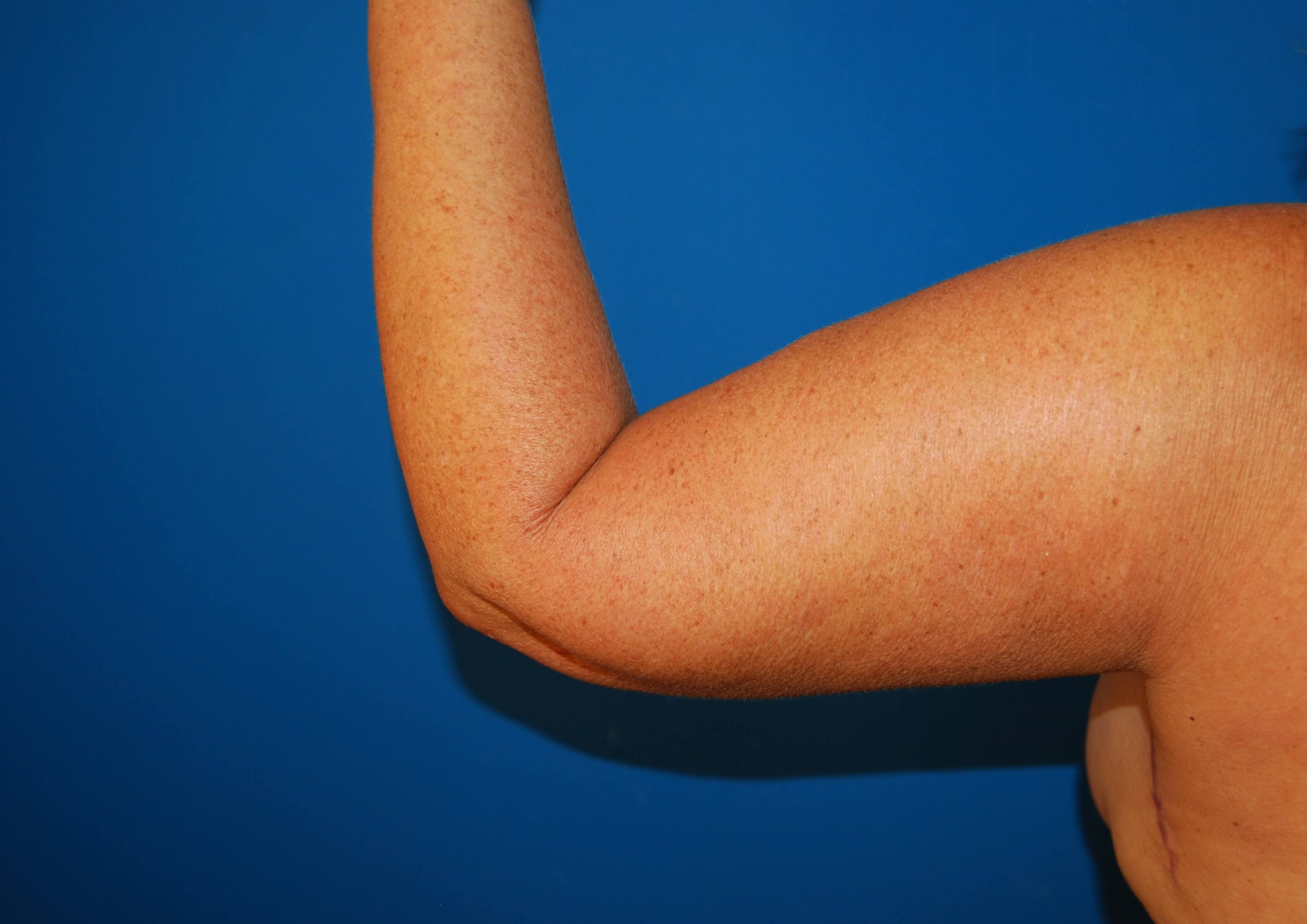 Outer View - Left 3 Months After Arm Lift
