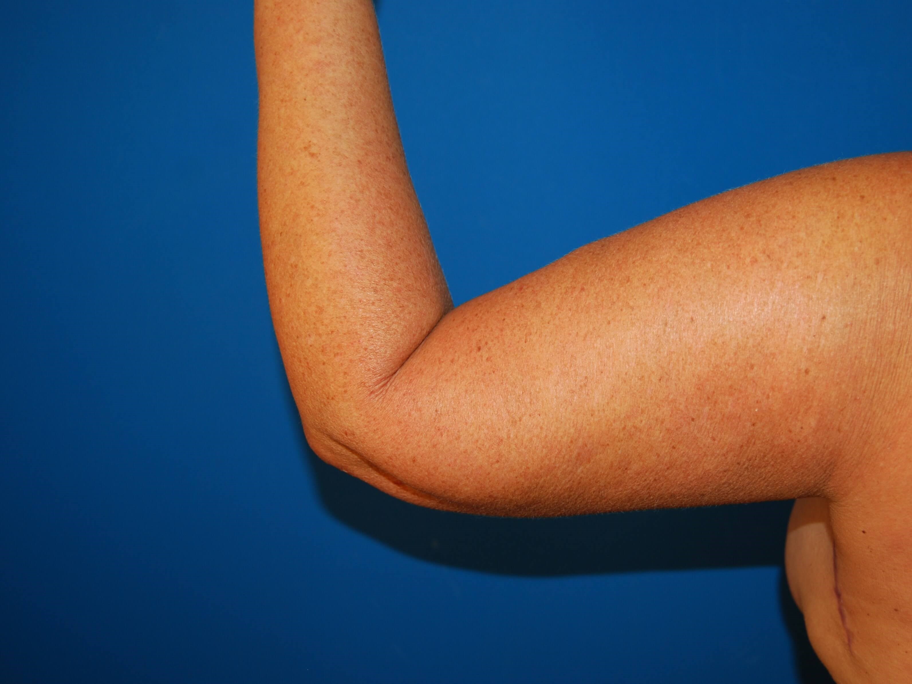 Outer View - Left 3 Months After Arm Lift