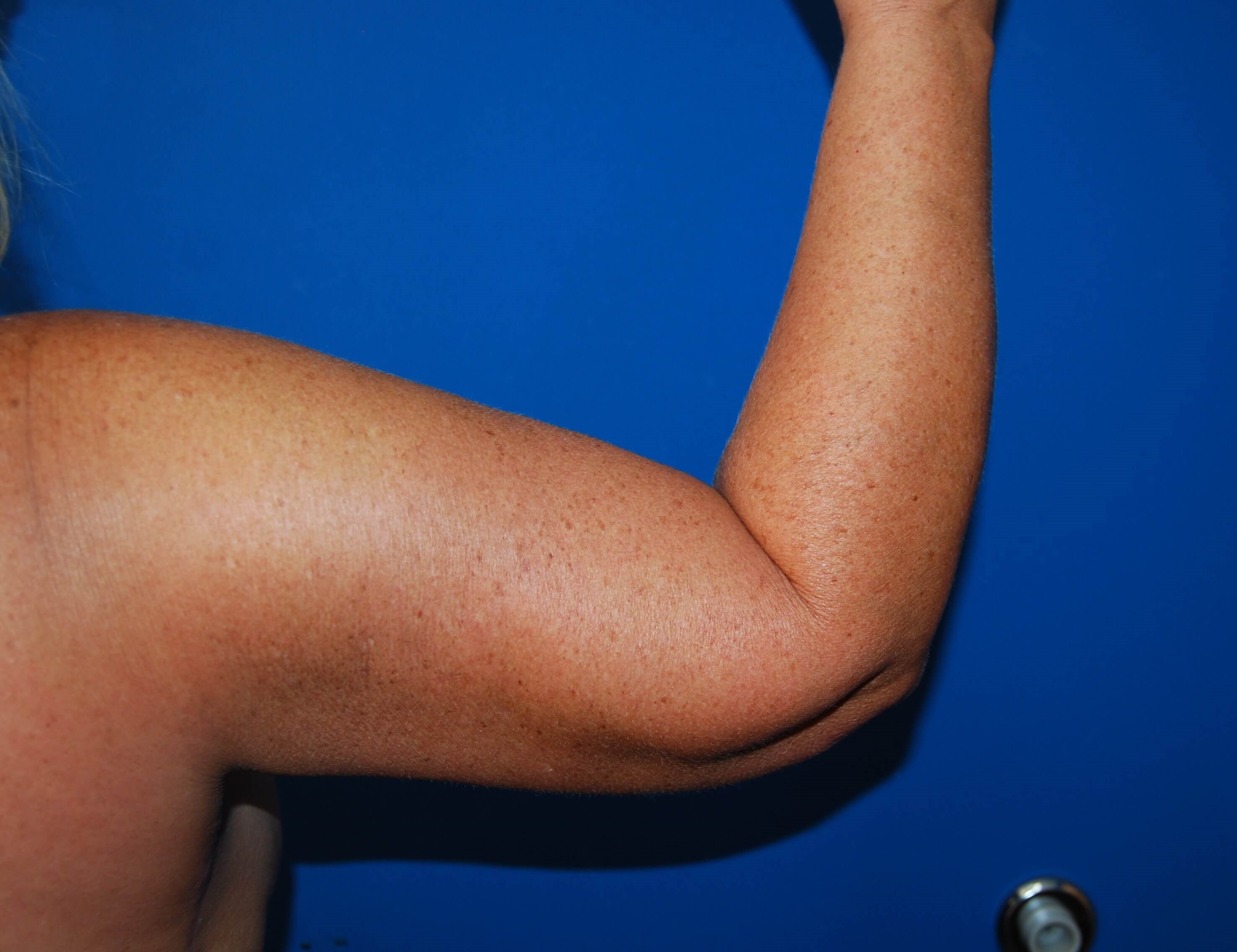 Outer View - Right 3 Months After Arm Lift