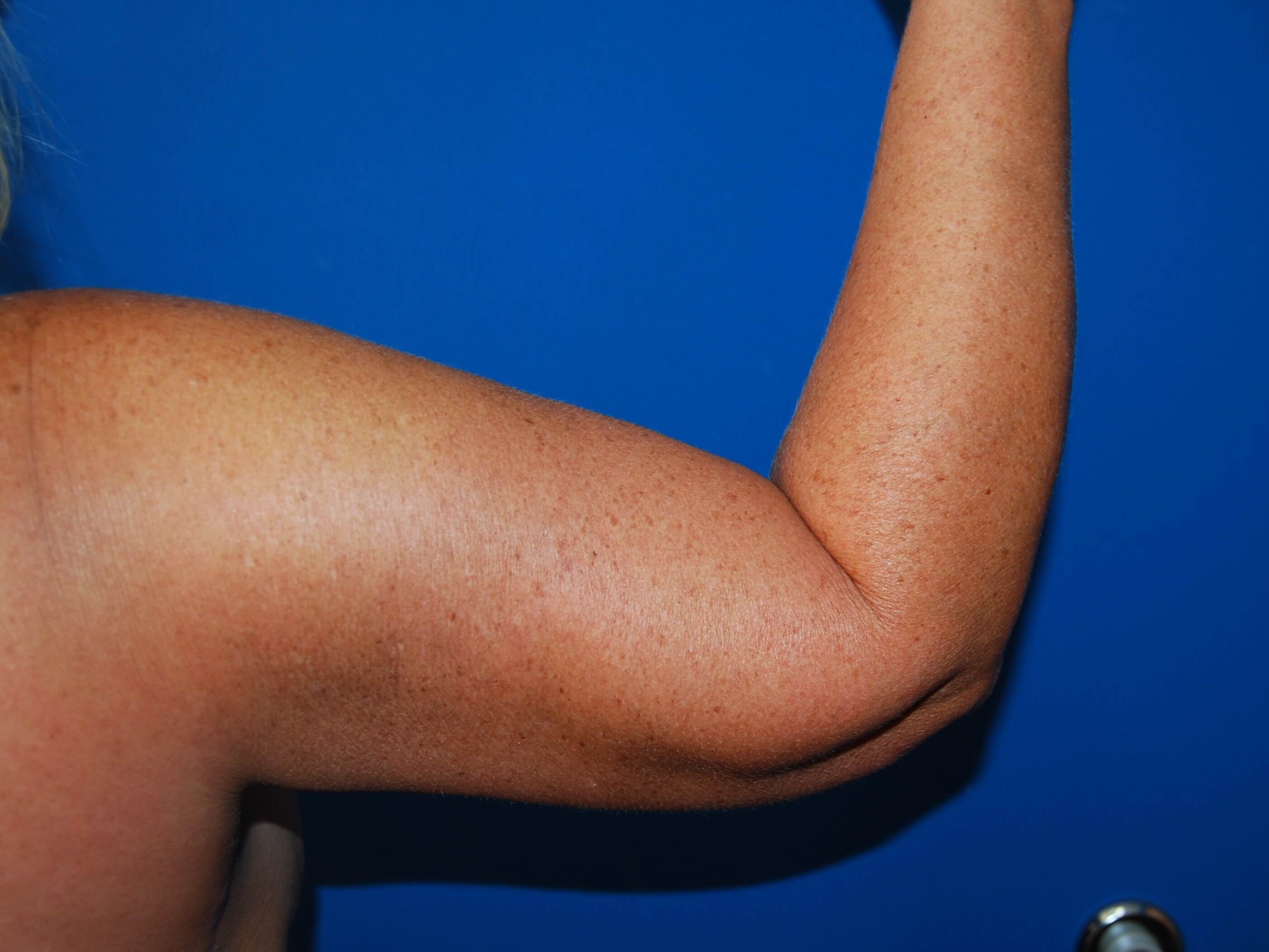 Outer View - Right 3 Months After Arm Lift