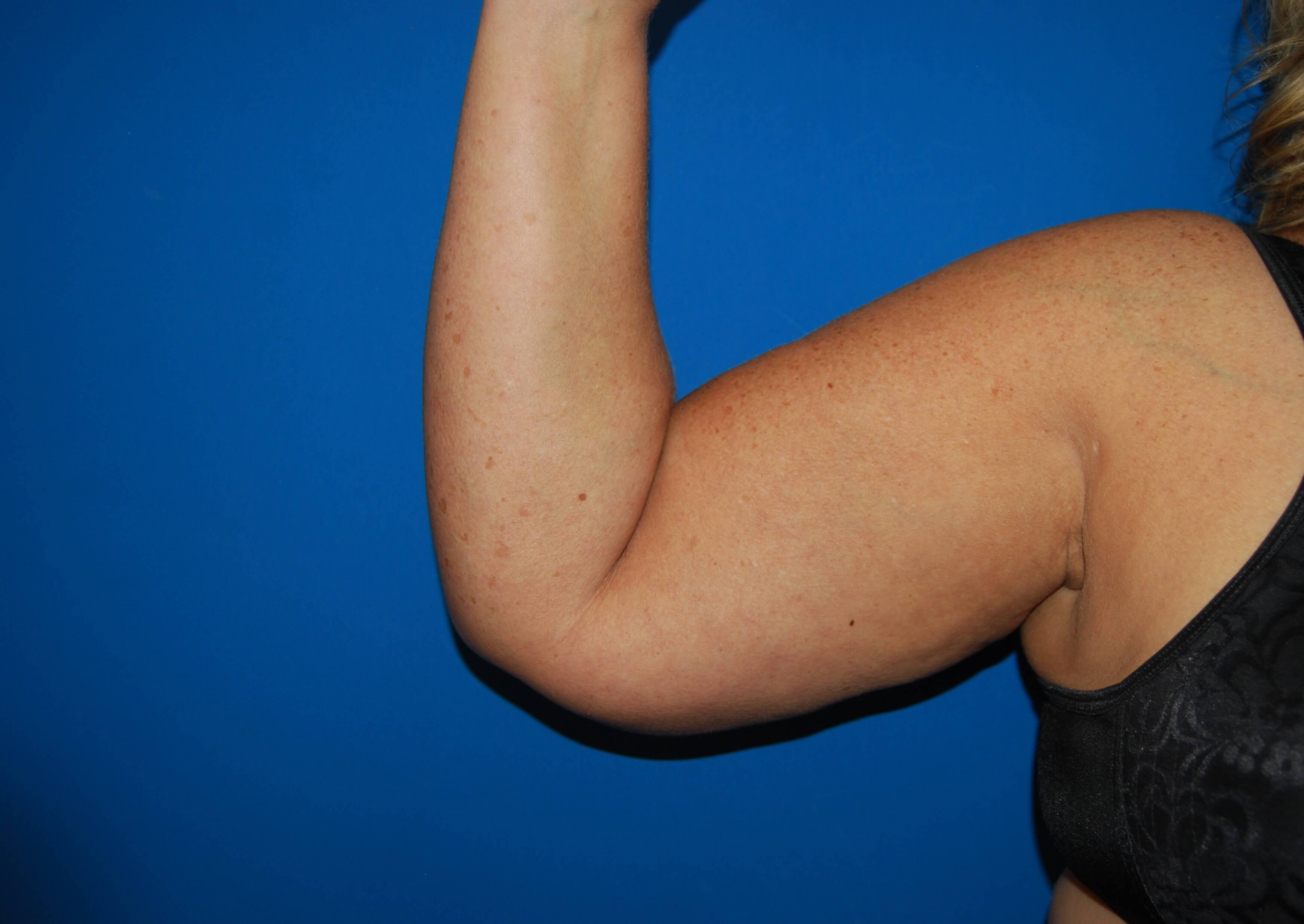 Inner Arm- Right Before  Arm Lift